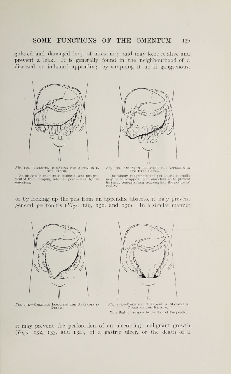gulated and damaged loop of intestine ; and may keep it alive and prevent a leak. It is generally found in the neighbourhood of a diseased or inflamed appendix ; bv wrapping it up if gangrenous, Fig. 129.—Omentum Isolating the Appendix in the Flank. An abscess is frequentl3r localized, and pus pre¬ vented from escaping into the peritoneum, by the omentum. Fig. 130.—Omentum Isolating the Appendix in the Iliac Fossa. The wholly gangrenous and perforated appendix may be so wrapped up in omentum as to prevent its septic contents from escaping into the peritoneal cavitv. or by locking up the pus from an appendix abscess, it may prevent general peritonitis {Figs. 129, 130, and 131). In a similar manner Fig. 131.—Omentum Isolating the Appendix in Pelvis. Fig. 132.—Omentum Guarding a Malignant Ulcer of the Rectum. Note that it has gone to the floor of the pelvis. it may prevent the perforation of an ulcerating malignant growth {Figs. 132, 133, and 134), of a gastric ulcer, or the death of a