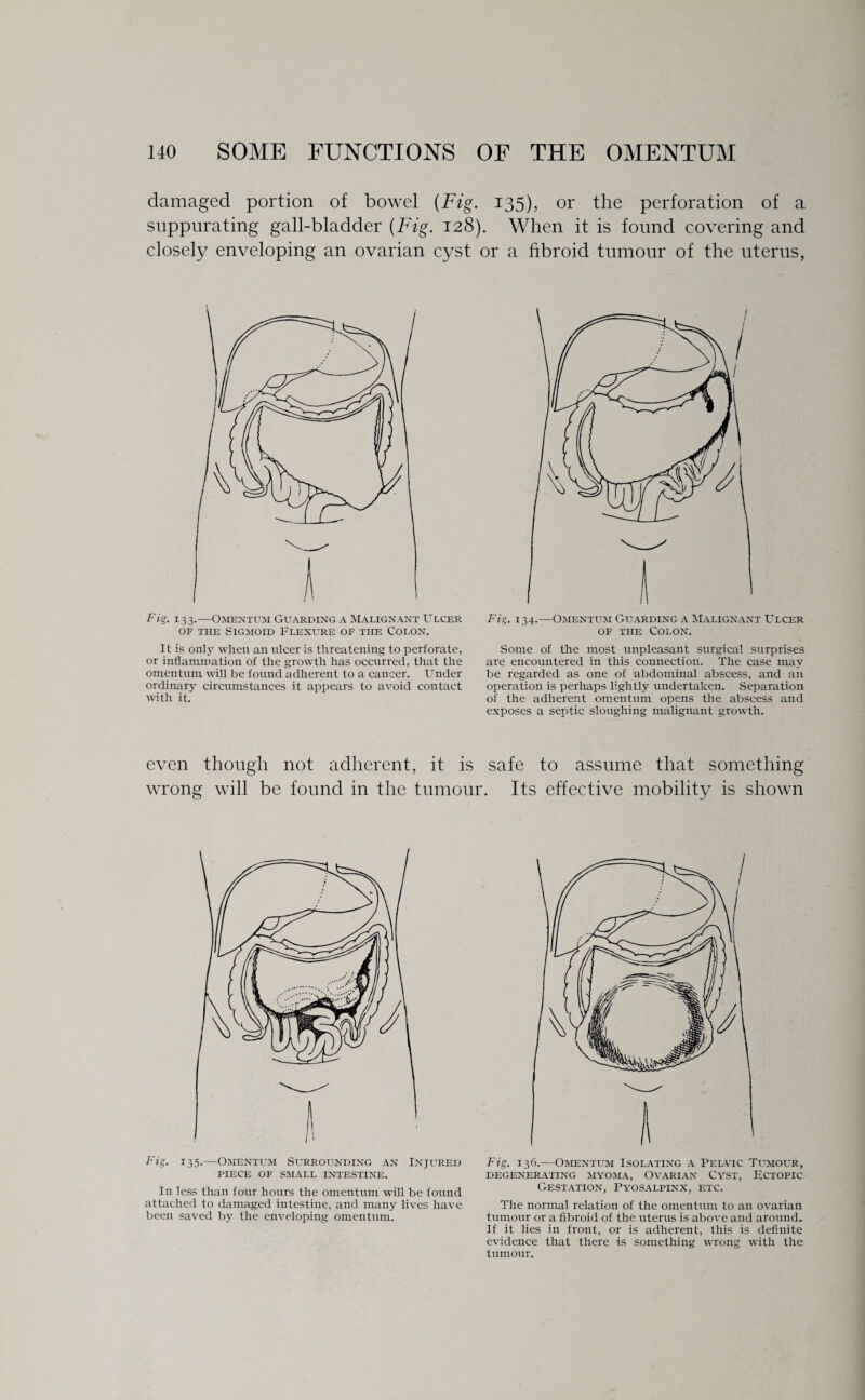 damaged portion of bowel (Fig. 135), or the perforation of a suppurating gall-bladder (Fig. 128). When it is found covering and closely enveloping an ovarian cyst or a fibroid tumour of the uterus, Fig. 133.—Omentum Guarding a Malignant Ulcer of the Sigmoid Flexure of the Colon. It is only when an nicer is threatening to perforate, or inflammation of the growth has occurred, that the omentum will be found adherent to a cancer. Under ordinary circumstances it appears to avoid contact with it. Fig. 134.—Omentum Guarding a Malignant Ulcer of the Colon. Some of the most unpleasant surgical surprises are encountered in this connection. The case may be regarded as one of abdominal abscess, and an operation is perhaps lightly undertaken. Separation of the adherent omentum opens the abscess and exposes a septic sloughing malignant growth. even though not adherent, it is safe to assume that something wrong will be found in the tumour. Its effective mobility is shown Fig. 135.—Omentum Surrounding an Injured PIECE OF SMALL INTESTINE. In less than four hours the omentum will be found attached to damaged intestine, and many lives have been saved by the enveloping omentum. Fig. 136.—Omentum Isolating a Pelvic Tumour, DEGENERATING MYOMA, OVARIAN CYST, UCTOPIC Gestation, Pyosalpinx, etc. The normal relation of the omentum to an ovarian tumour or a fibroid of the uterus is above and around. If it lies in front, or is adherent, this is definite evidence that there is something wrong with the tumour.