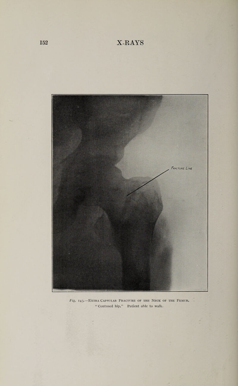 Fig. 143.—Extra Capsular Fracture of the Neck of the Femur, “ Contused hip.” Patient able to walk.