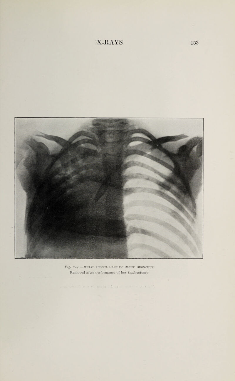 Fig. 144.—Metal Pencil Case in Right Bronchus, Removed after performance of low tracheotomy