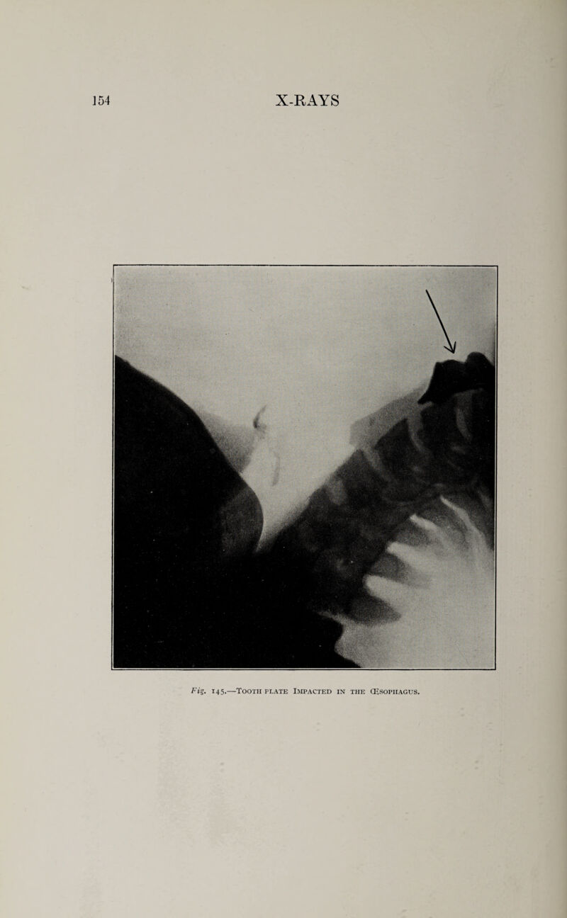 Fi°. 145.—Tooth plate Impacted in the (Esophagus.