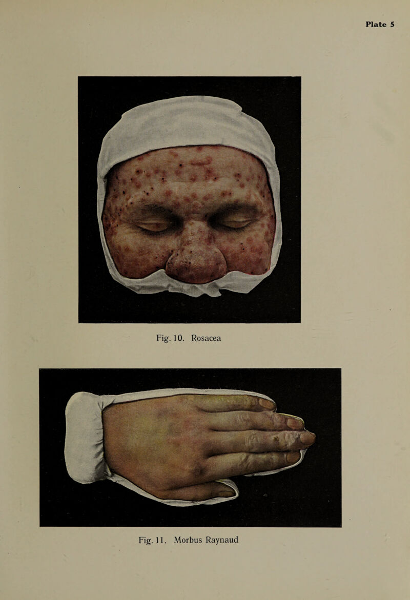 Fig. 10. Rosacea