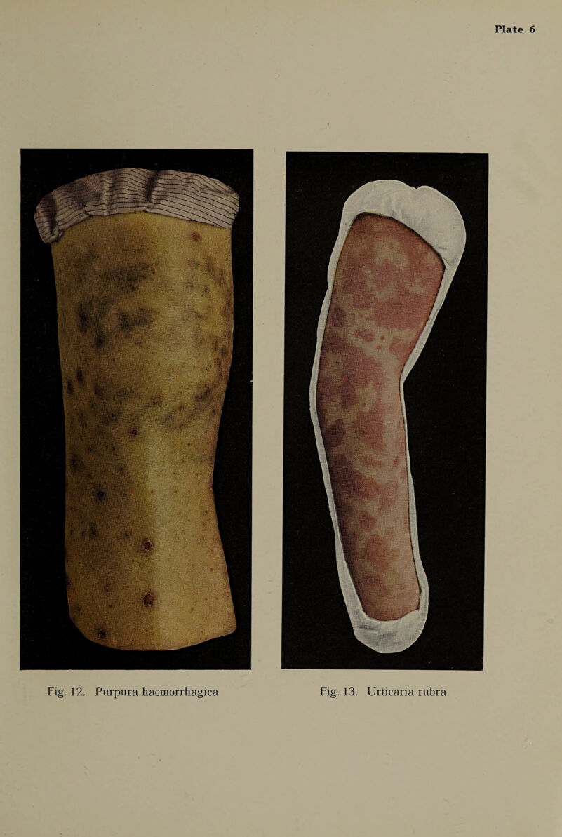 Fig. 12. Purpura haemorrhagica Fig. 13. Urticaria rubra