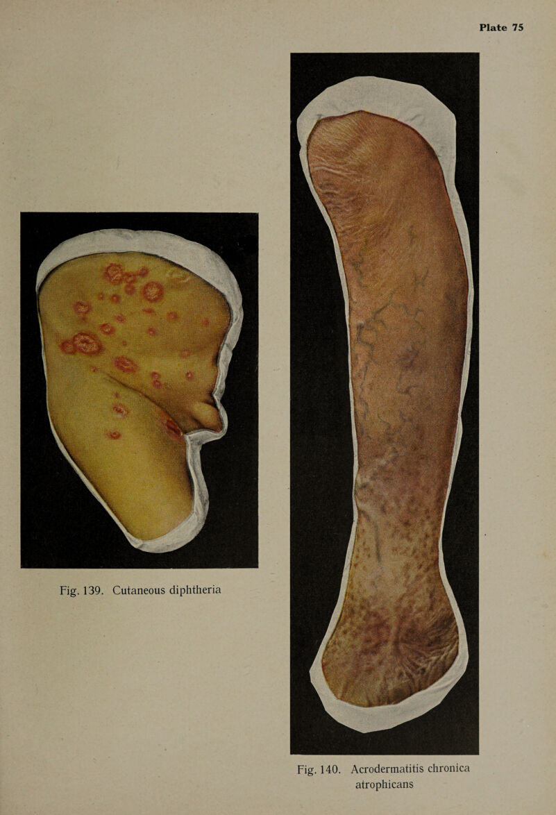 Fig. 139. Cutaneous diphtheria Fig. 140. Acrodermatitis chronica atrophicans