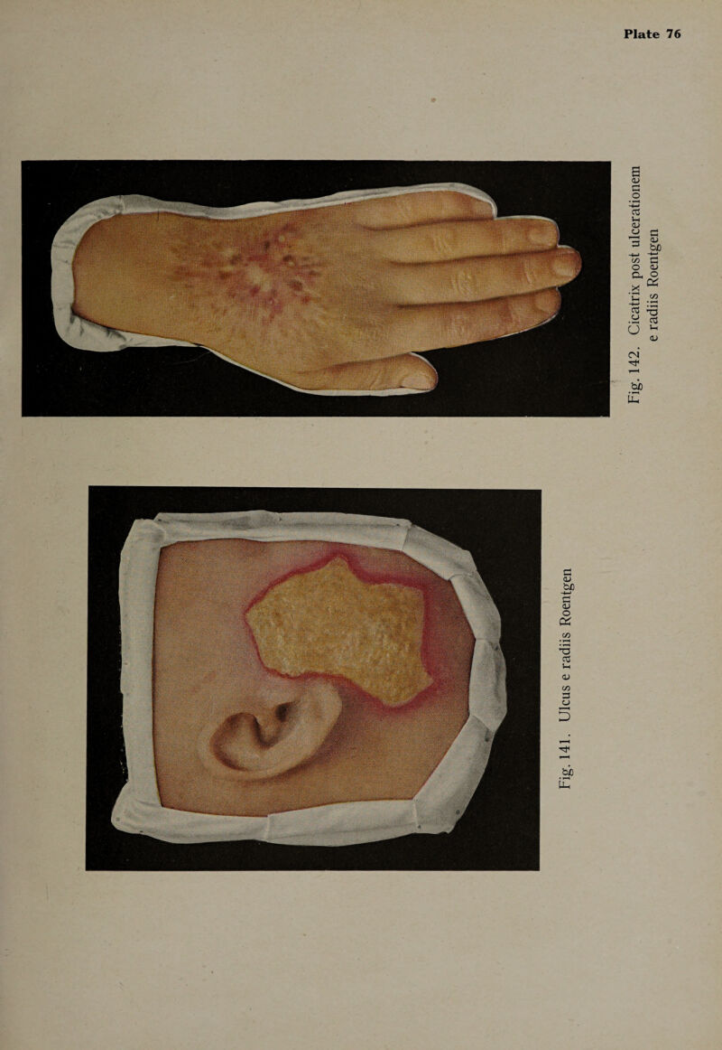 Fig. 142. Cicatrix post ulcerationem e radiis Roentgen