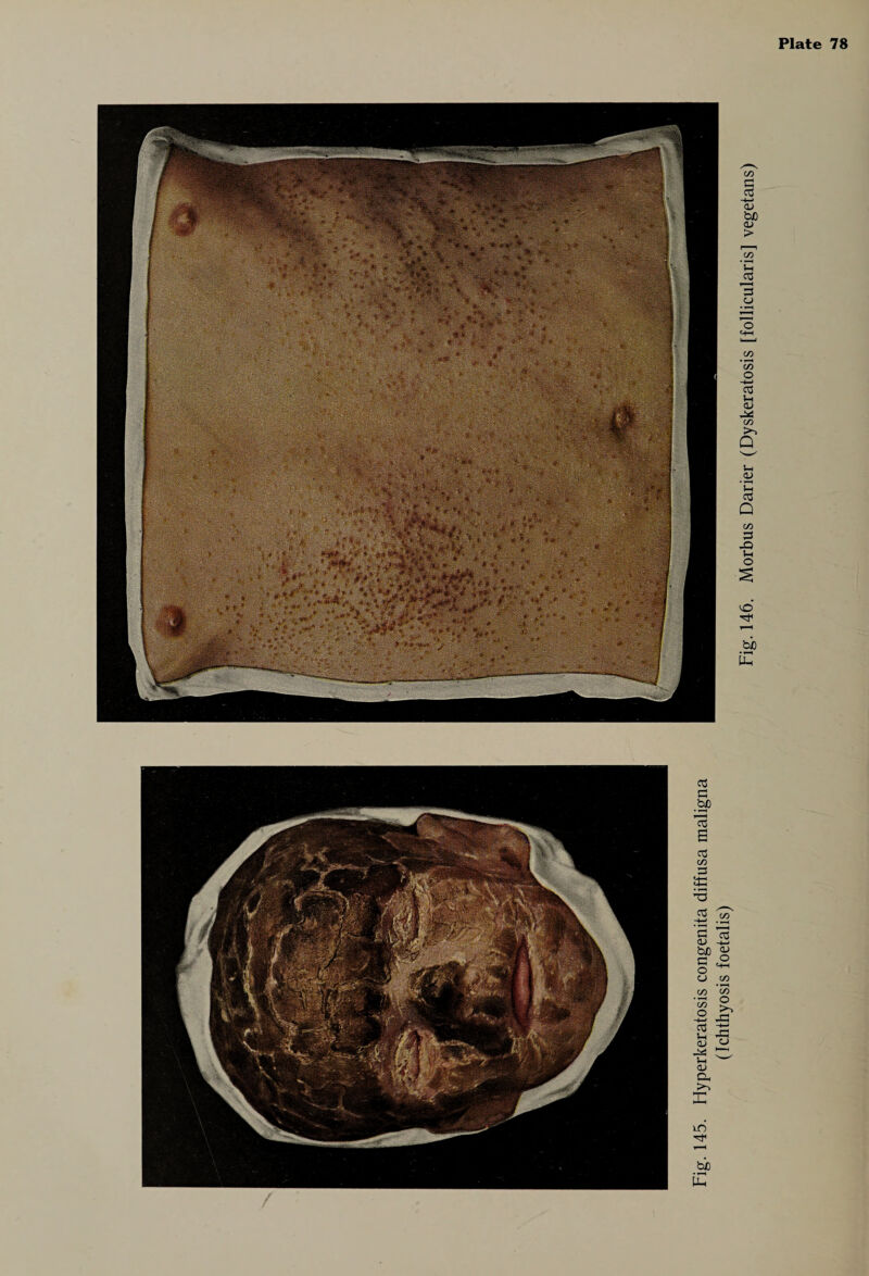 (Ichthyosis foetalis)