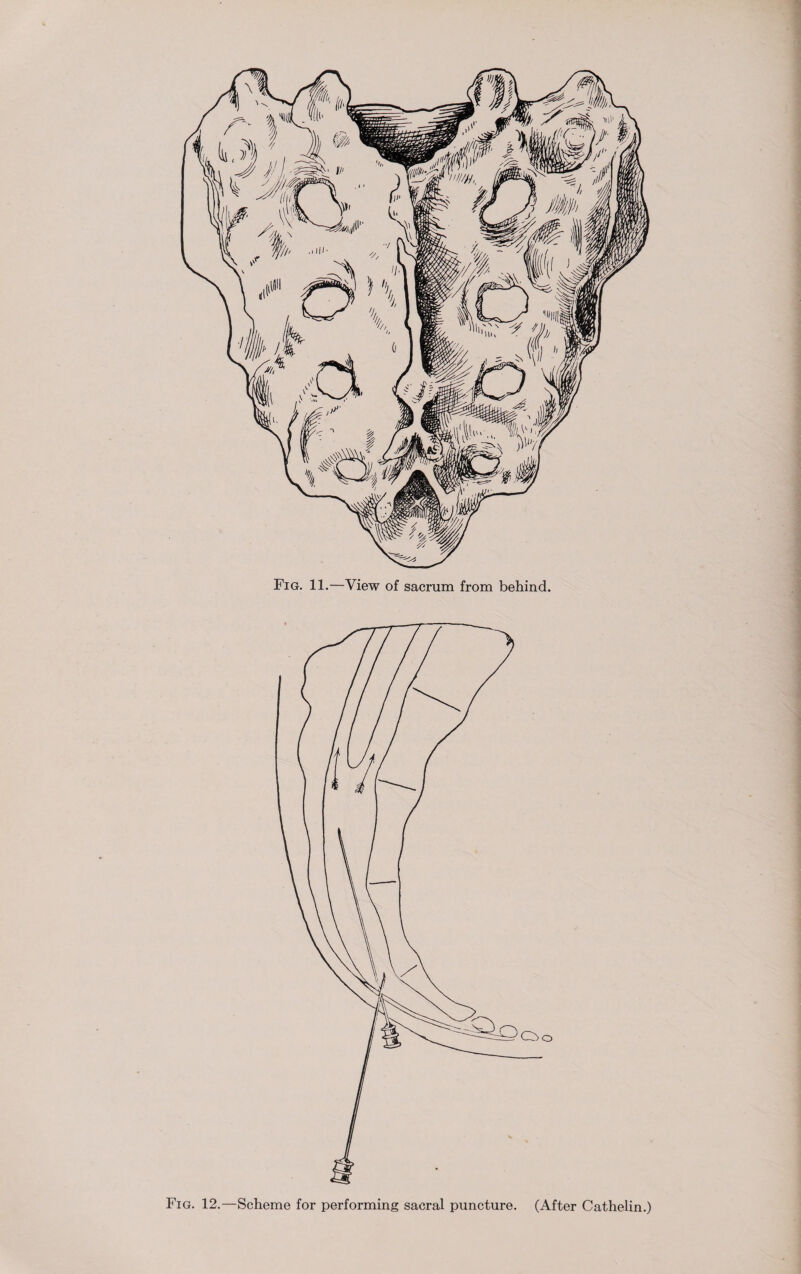 Fig. 11.—View of sacrum from behind. Fig. 12.—Scheme for performing sacral puncture. (After Cathelin.)