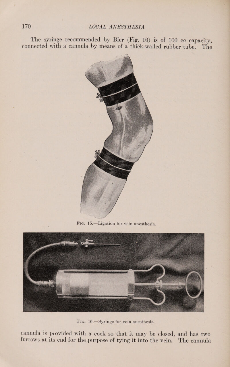 The syringe recommended by Bier (Fig. 16) is of 100 cc capacity, connected with a cannula by means of a thick-walled rubber tube. The Fig. 15.—Ligation for vein anesthesia. Fig. 16.—Syringe for vein anesthesia. cannula is provided with a cock so that it may be closed, and has two furrows at its end for the purpose of tying it into the vein. The cannula