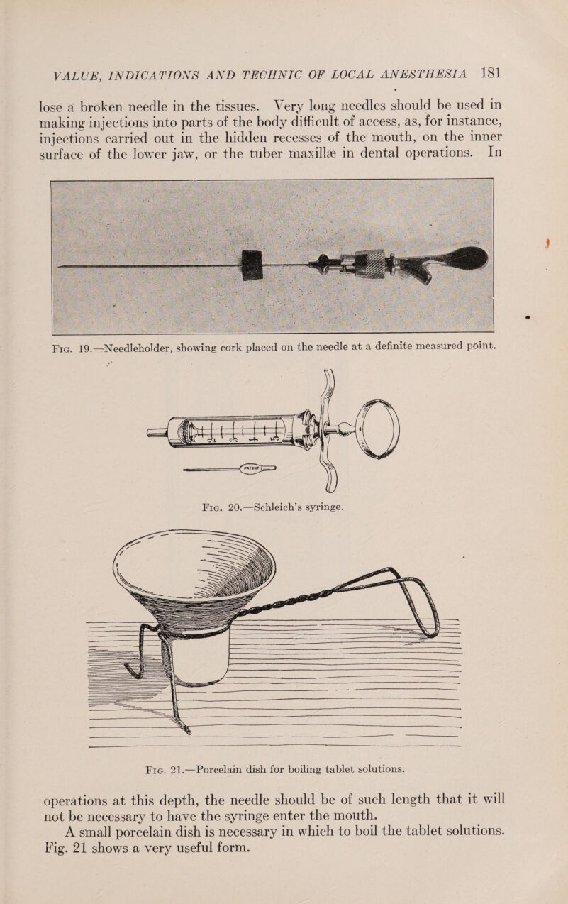 lose a broken needle in the tissues. Very long needles should be used in making injections into parts of the body difficult of access, as, for instance, injections carried out in the hidden recesses of the mouth, on the inner surface of the lower jaw, or the tuber maxillse in dental operations. In Fig. 19.—Needleholder, showing cork placed on the needle at a definite measured point. Fig. 21.—Porcelain dish for boiling tablet solutions. operations at this depth, the needle should be of such length that it will not be necessary to have the syringe enter the mouth. A small porcelain dish is necessary in which to boil the tablet solutions. Fig. 21 shows a very useful form.