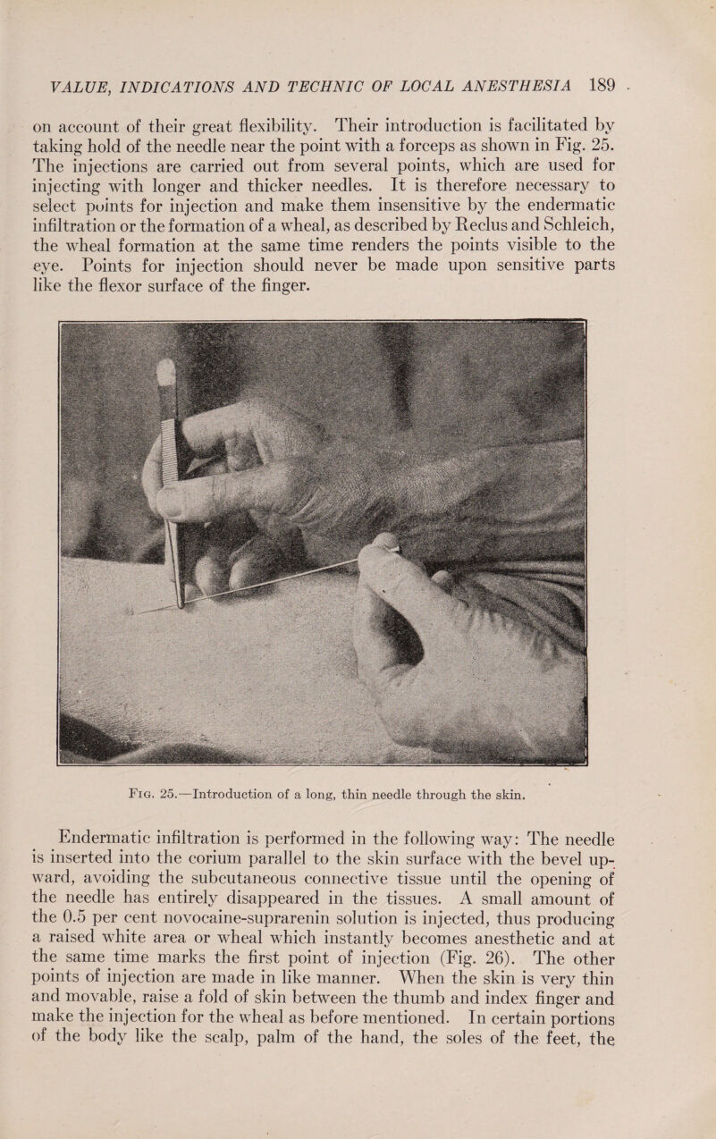 on account of their great flexibility. Their introduction is facilitated by taking hold of the needle near the point with a forceps as shown in Fig. 25. The injections are carried out from several points, which are used for injecting with longer and thicker needles. It is therefore necessary to select points for injection and make them insensitive by the endermatic infiltration or the formation of a wheal, as described by Reclus and Schleich, the wheal formation at the same time renders the points visible to the eye. Points for injection should never be made upon sensitive parts like the flexor surface of the finger. Fig. 25.—Introduction of a long, thin needle through the skin. Endermatic infiltration is performed in the following way: The needle is inserted into the corium parallel to the skin surface with the bevel up¬ ward, avoiding the subcutaneous connective tissue until the opening of the needle has entirely disappeared in the tissues. A small amount of the 0.5 per cent novocaine-suprarenin solution is injected, thus producing a raised white area or wheal which instantly becomes anesthetic and at the same time marks the first point of injection (Fig. 26). The other points of injection are made in like manner. When the skin is very thin and movable, raise a fold of skin between the thumb and index finger and make the injection for the wheal as before mentioned. In certain portions of the body like the scalp, palm of the hand, the soles of the feet, the