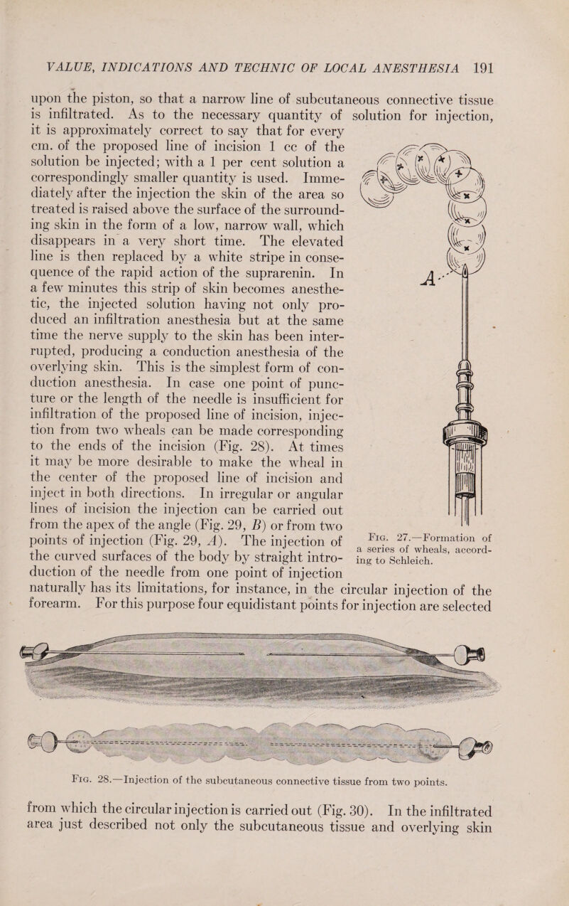 upon the piston, so that a narrow line of subcutaneous connective tissue is infiltrated. As to the necessary quantity of solution for injection, it is approximately correct to say that for every cm. of the proposed line of incision 1 cc of the solution be injected; with a 1 per cent solution a correspondingly smaller quantity is used. Imme¬ diately after the injection the skin of the area so treated is raised above the surface of the surround¬ ing skin in the form of a low, narrow wall, which disappears in a very short time. The elevated line is then replaced by a white stripe in conse¬ quence of the rapid action of the suprarenin. In a few minutes this strip of skin becomes anesthe¬ tic, the injected solution having not only pro¬ duced an infiltration anesthesia but at the same time the nerve supply to the skin has been inter¬ rupted, producing a conduction anesthesia of the overlying skin. This is the simplest form of con¬ duction anesthesia. In case one point of punc¬ ture or the length of the needle is insufficient for infiltration of the proposed line of incision, injec¬ tion from twm wheals can be made corresponding to the ends of the incision (Fig. 28). At times it may be more desirable to make the wheal in the center of the proposed line of incision and inject in both directions. In irregular or angular lines of incision the injection can be carried out from the apex of the angle (Fig. 29, B) or from two points of injection (Fig. 29, A). The injection of Fig- 27-—Formation of tne curved surfaces of the body by straight mtro- ing to Schleich, duction of the needle from one point of injection naturally has its limitations, for instance, in the circular injection of the forearm. For this purpose four equidistant points for injection are selected Fig. 28. Injection of the subcutaneous connective tissue from two points. from which the circular injection is carried out (Fig. 30). In the infiltrated area just described not only the subcutaneous tissue and overlying skin