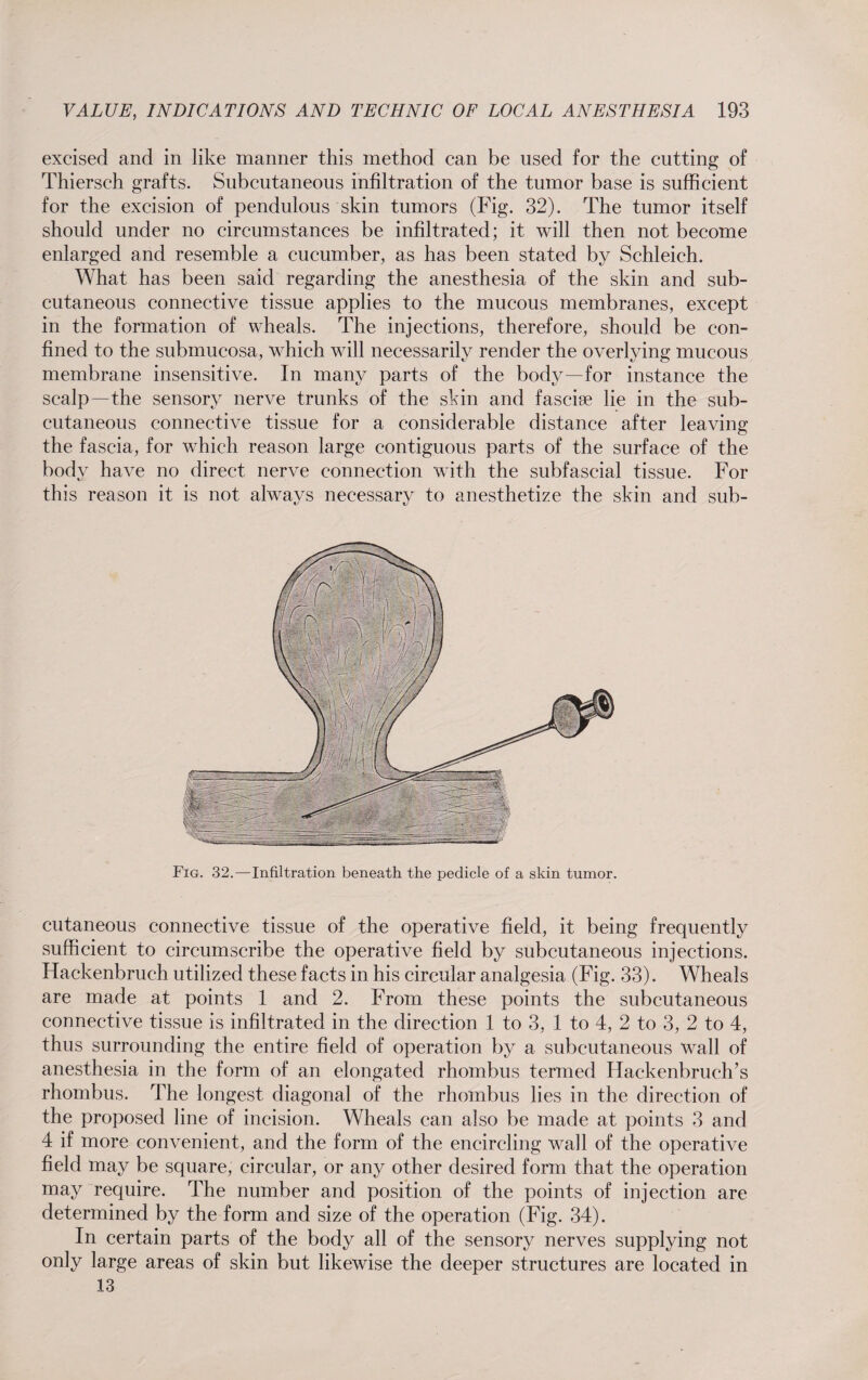 excised and in like manner this method can be used for the cutting of Thiersch grafts. Subcutaneous infiltration of the tumor base is sufficient for the excision of pendulous skin tumors (Fig. 32). The tumor itself should under no circumstances be infiltrated; it will then not become enlarged and resemble a cucumber, as has been stated by Schleich. What has been said regarding the anesthesia of the skin and sub¬ cutaneous connective tissue applies to the mucous membranes, except in the formation of wheals. The injections, therefore, should be con¬ fined to the submucosa, which will necessarily render the overlying mucous membrane insensitive. In many parts of the body—for instance the scalp—the sensory nerve trunks of the skin and fascise lie in the sub¬ cutaneous connective tissue for a considerable distance after leaving the fascia, for which reason large contiguous parts of the surface of the body have no direct nerve connection with the subfascial tissue. For this reason it is not always necessary to anesthetize the skin and sub- Fig. 32.—Infiltration beneath the pedicle of a skin tumor. cutaneous connective tissue of the operative field, it being frequently sufficient to circumscribe the operative field by subcutaneous injections. Hackenbruch utilized these facts in his circular analgesia (Fig. 33). Wheals are made at points 1 and 2. From these points the subcutaneous connective tissue is infiltrated in the direction 1 to 3, 1 to 4, 2 to 3, 2 to 4, thus surrounding the entire field of operation by a subcutaneous wall of anesthesia in the form of an elongated rhombus termed Hackenbruch’s rhombus. The longest diagonal of the rhombus lies in the direction of the proposed line of incision. Wheals can also be made at points 3 and 4 if more convenient, and the form of the encircling wall of the operative field may be square, circular, or any other desired form that the operation may require. The number and position of the points of injection are determined by the form and size of the operation (Fig. 34). In certain parts of the body all of the sensory nerves supplying not only large areas of skin but likewise the deeper structures are located in 13