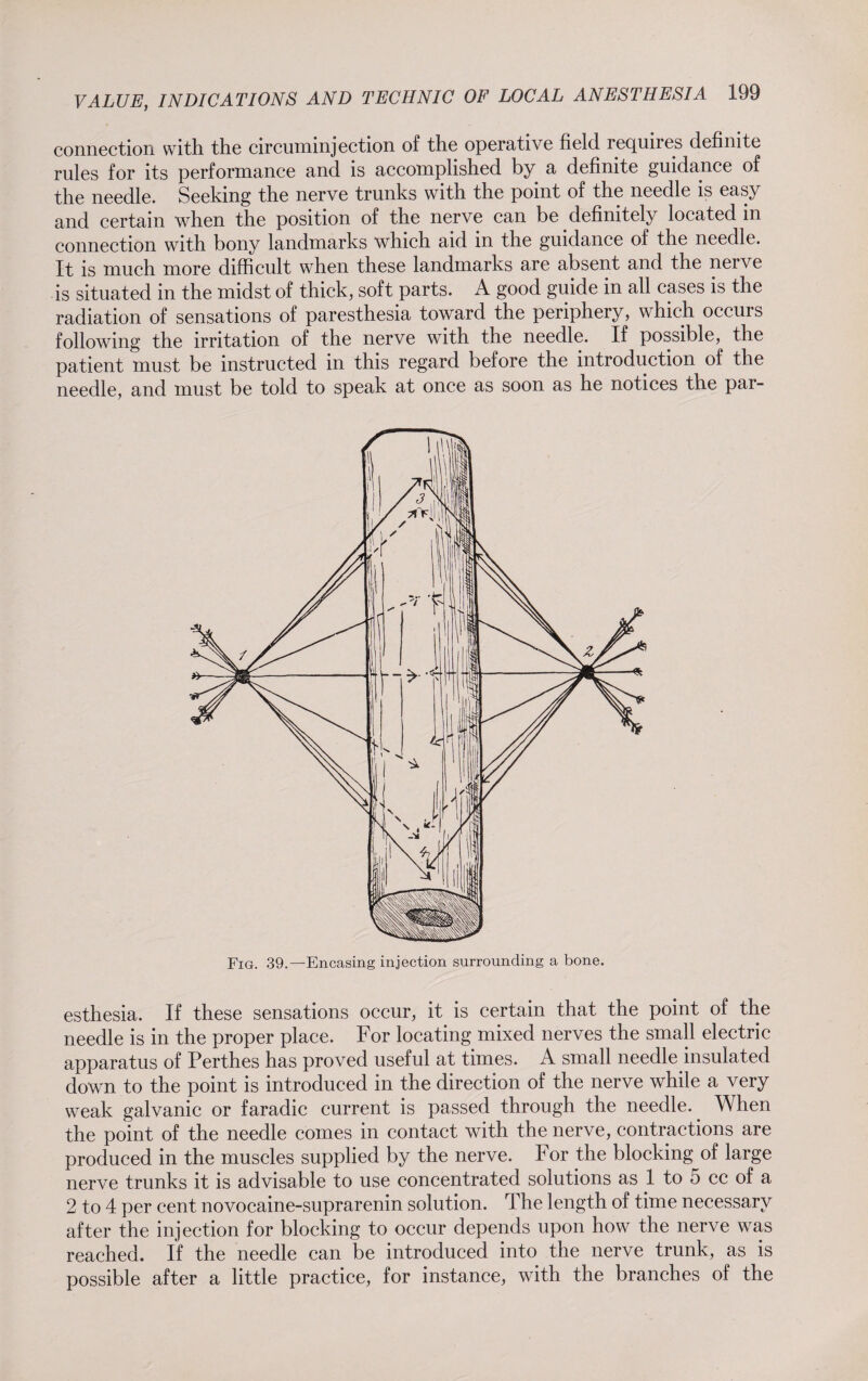 connection with the circuminjection of the operative field requires definite rules for its performance and is accomplished by a definite guidance of the needle. Seeking the nerve trunks with the point of the needle is easy and certain when the position of the nerve can be definitely located in connection with bony landmarks which aid in the guidance of the needle. It is much more difficult when these landmarks are absent and the nerve is situated in the midst of thick, soft parts. A good guide in all cases is the radiation of sensations of paresthesia toward the periphery, which occurs following the irritation of the nerve with the needle. If possible, the patient must be instructed in this regard before the introduction of the needle, and must be told to speak at once as soon as he notices the par- Fig. 39.—Encasing injection surrounding a bone. esthesia. If these sensations occur, it is certain that the point of the needle is in the proper place. For locating mixed nerves the small electric apparatus of Perthes has proved useful at times. A small needle insulated down to the point is introduced in the direction of the nerve while a very weak galvanic or faradic current is passed through the needle.. When the point of the needle comes in contact with the nerve, contractions are produced in the muscles supplied by the nerve. For the blocking of large nerve trunks it is advisable to use concentrated solutions as 1 to 5 cc of a 2 to 4 per cent novocaine-suprarenin solution. The length of time necessary after the injection for blocking to occur depends upon how the nerve was reached. If the needle can be introduced into the nerve trunk, as is possible after a little practice, for instance, with the branches of the