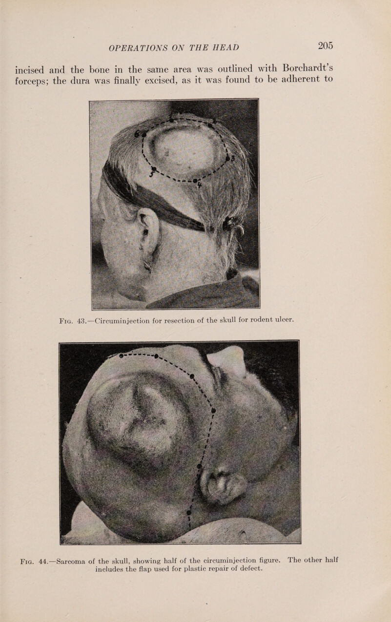 incised and the bone in the same area was outlined with Borchardt’s forceps; the dura was finally excised, as it was found to be adherent to Fig. 43.—Circuminjection for resection of the skull for rodent ulcer. Fig. 44.—Sarcoma of the skull, showing half of the circuminjection figure. The other half includes the flap used for plastic repair of defect.