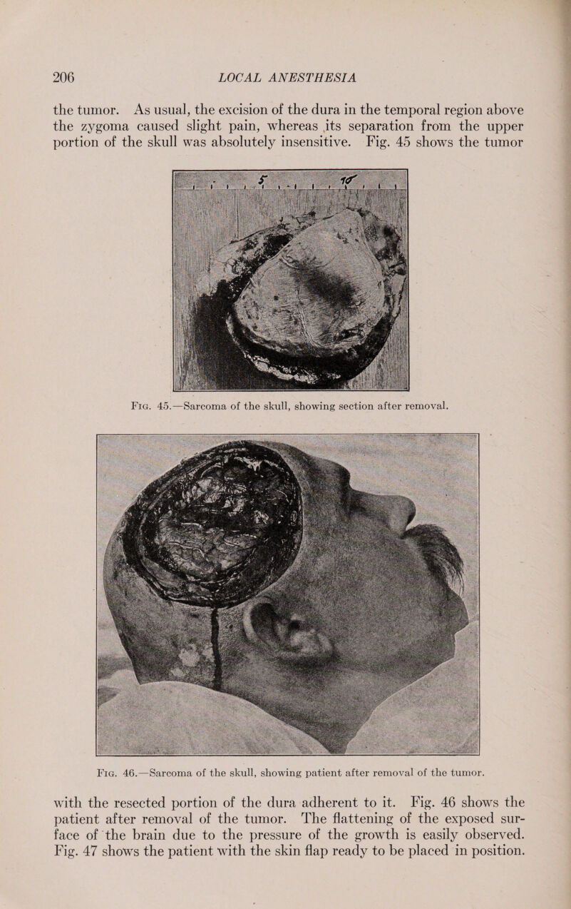 the tumor. As usual, the excision of the dura in the temporal region above the zygoma caused slight pain, whereas its separation from the upper portion of the skull was absolutely insensitive. Fig. 45 shows the tumor Fig. 45.—Sarcoma of the skull, showing section after removal. Fig. 46.—Sarcoma of the skull, showing patient after removal of the tumor. with the resected portion of the dura adherent to it. Fig. 46 shows the patient after removal of the tumor. The flattening of the exposed sur¬ face of the brain due to the pressure of the growth is easily observed. Fig. 47 shows the patient with the skin flap ready to be placed in position.