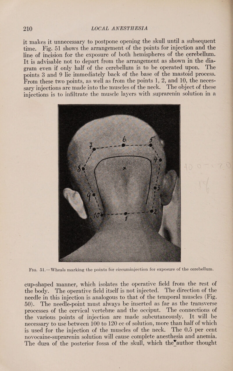 it makes it unnecessary to postpone opening the skull until a subsequent time. Fig. 51 shows the arrangement of the points for injection and the line of incision for the exposure of both hemispheres of the cerebellum. It is advisable not to depart from the arrangement as shown in the dia¬ gram even if only half of the cerebellum is to be operated upon. The points 3 and 9 lie immediately back of the base of the mastoid process. From these two points, as well as from the points 1, 2, and 10, the neces¬ sary injections are made into the muscles of the neck. The object of these injections is to infiltrate the muscle layers with suprarenin solution in a Fig. 51.—Wheals marking the points for circuminjection for exposure of the cerebellum. cup-shaped manner, which isolates the operative field from the rest of the body. The operative field itself is not injected. The direction of the needle in this injection is analogous to that of the temporal muscles (Fig. 50). The needle-point must always be inserted as far as the transverse processes of the cervical vertebrae and the occiput. The connections of the various points of injection are made subcutaneously. It will be necessary to use between 100 to 120 cc of solution, more than half of which is used for the injection of the muscles of the neck. The 0.5 per cent novocaine-suprarenin solution will cause complete anesthesia and anemia. The dura of the posterior fossa of the skull, which the*author thought