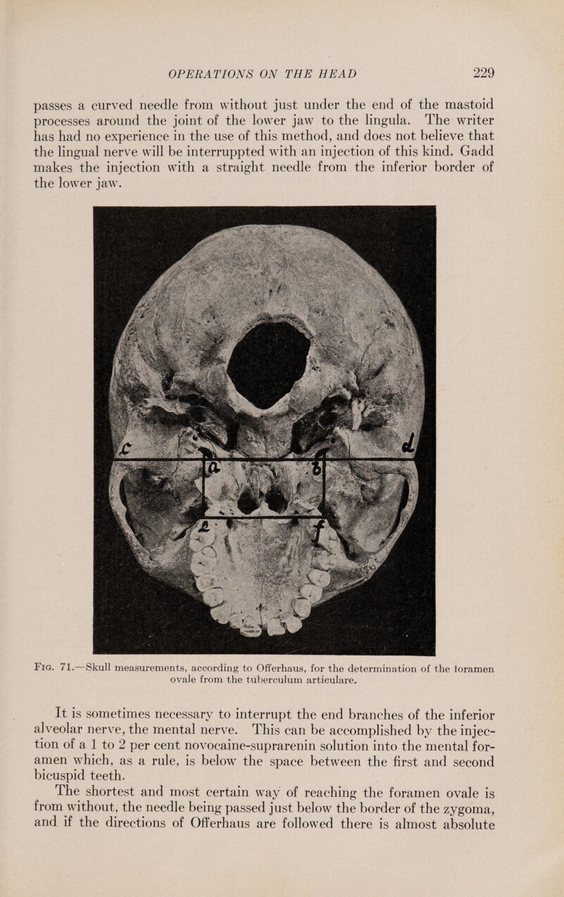 passes a curved needle from without just under the end of the mastoid processes around the joint of the lower jaw to the lingula. The writer has had no experience in the use of this method, and does not believe that the lingual nerve will be interruppted with an injection of this kind. Gadd makes the injection with a straight needle from the inferior border of the lower jaw. Fig. 71.—Skull measurements, according to Offerhaus, for the determination of the ioramen ovale from the tuberculum articulare. It is sometimes necessary to interrupt the end branches of the inferior alveolar nerve, the mental nerve. This can be accomplished by the injec¬ tion of a 1 to 2 per cent novocaine-suprarenin solution into the mental for¬ amen which, as a rule, is below the space between the first, and second bicuspid teeth. The shortest and most certain way of reaching the foramen ovale is from without, the needle being passed just below the border of the zygoma, and if the directions of Offerhaus are followed there is almost absolute