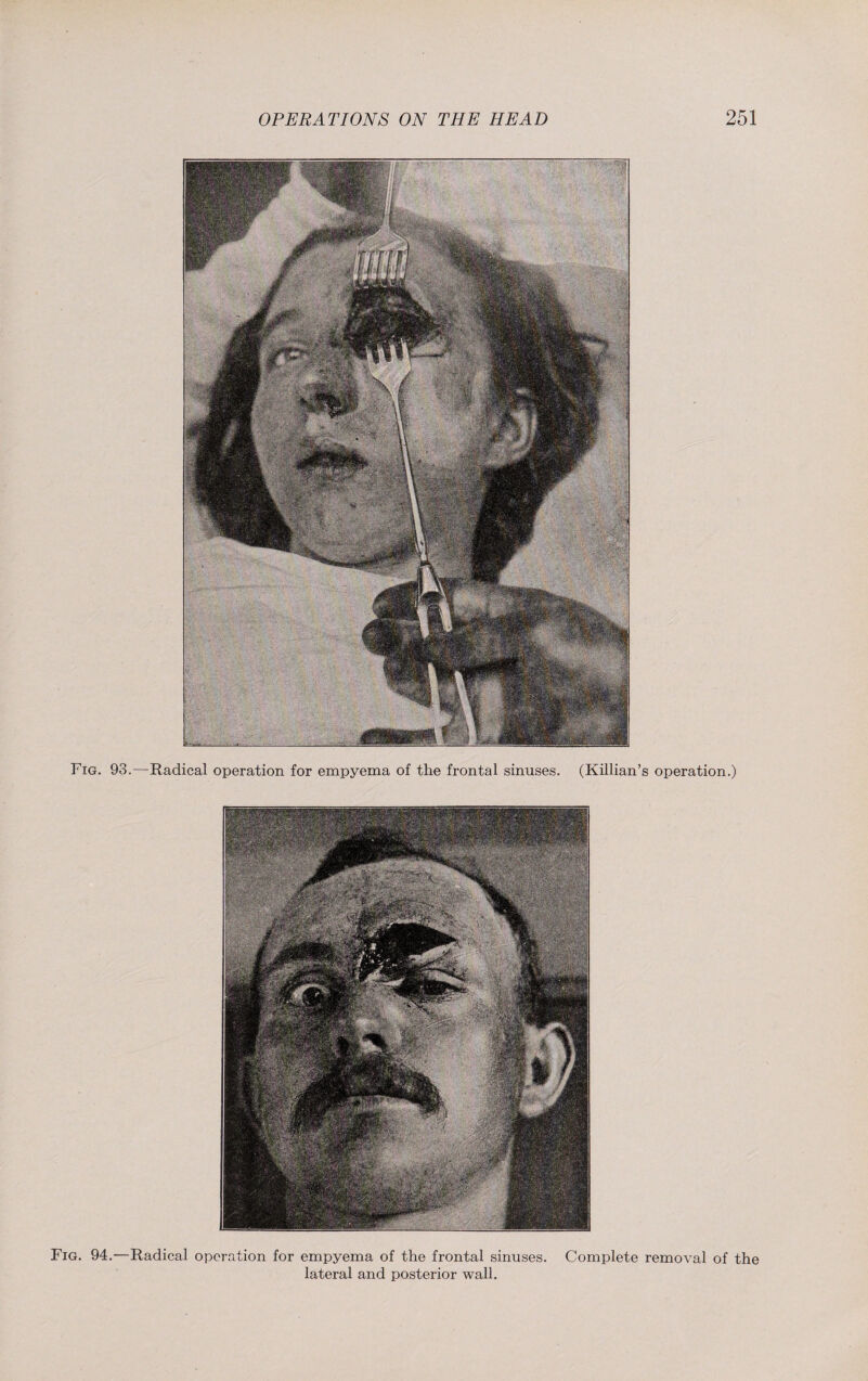 Fig. 93.—Radical operation for empyema of the frontal sinuses. (Killian’s operation.) Fig. 94.—Radical operation for empyema of the frontal sinuses. Complete removal of the lateral and posterior wall.