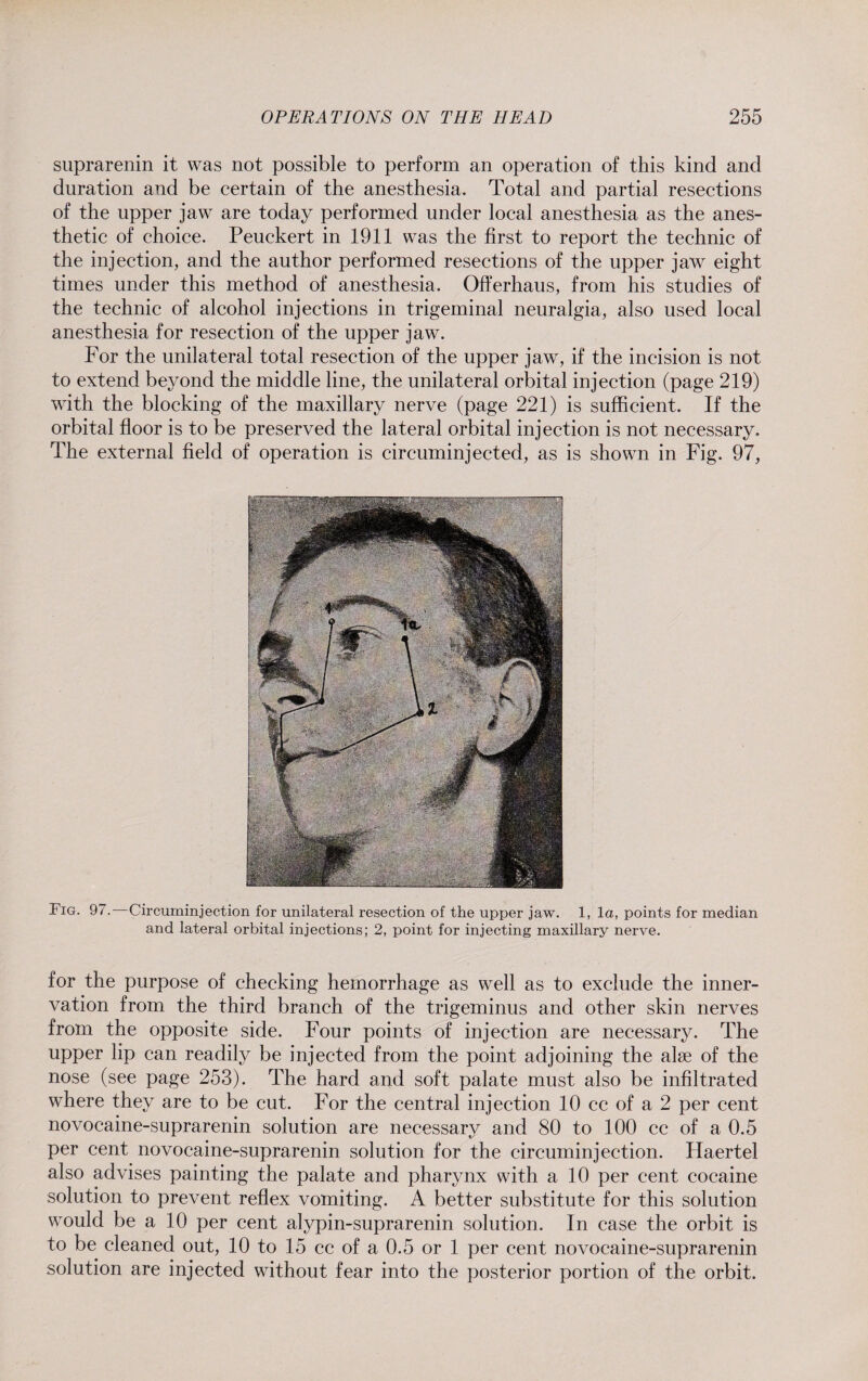 suprarenin it was not possible to perform an operation of this kind and duration and be certain of the anesthesia. Total and partial resections of the upper jaw are today performed under local anesthesia as the anes¬ thetic of choice. Peuckert in 1911 was the first to report the technic of the injection, and the author performed resections of the upper jaw eight times under this method of anesthesia. Offerhaus, from his studies of the technic of alcohol injections in trigeminal neuralgia, also used local anesthesia for resection of the upper jaw. For the unilateral total resection of the upper jaw, if the incision is not to extend beyond the middle line, the unilateral orbital injection (page 219) with the blocking of the maxillary nerve (page 221) is sufficient. If the orbital floor is to be preserved the lateral orbital injection is not necessary. The external field of operation is circuminjected, as is shown in Fig. 97, Fig. 97. Circuminjection for unilateral resection of the upper jaw. 1, la, points for median and lateral orbital injections; 2, point for injecting maxillary nerve. for the purpose of checking hemorrhage as well as to exclude the inner¬ vation from the third branch of the trigeminus and other skin nerves from the opposite side. Four points of injection are necessary. The upper lip can readily be injected from the point adjoining the alse of the nose (see page 253). The hard and soft palate must also be infiltrated where they are to be cut. For the central injection 10 cc of a 2 per cent novocaine-suprarenin solution are necessary and 80 to 100 cc of a 0.5 per cent novocaine-suprarenin solution for the circuminjection. Haertel also advises painting the palate and pharynx with a 10 per cent cocaine solution to prevent reflex vomiting. A better substitute for this solution would be a 10 per cent alypin-suprarenin solution. In case the orbit is to be cleaned out, 10 to 15 cc of a 0.5 or 1 per cent novocaine-suprarenin solution are injected without fear into the posterior portion of the orbit.