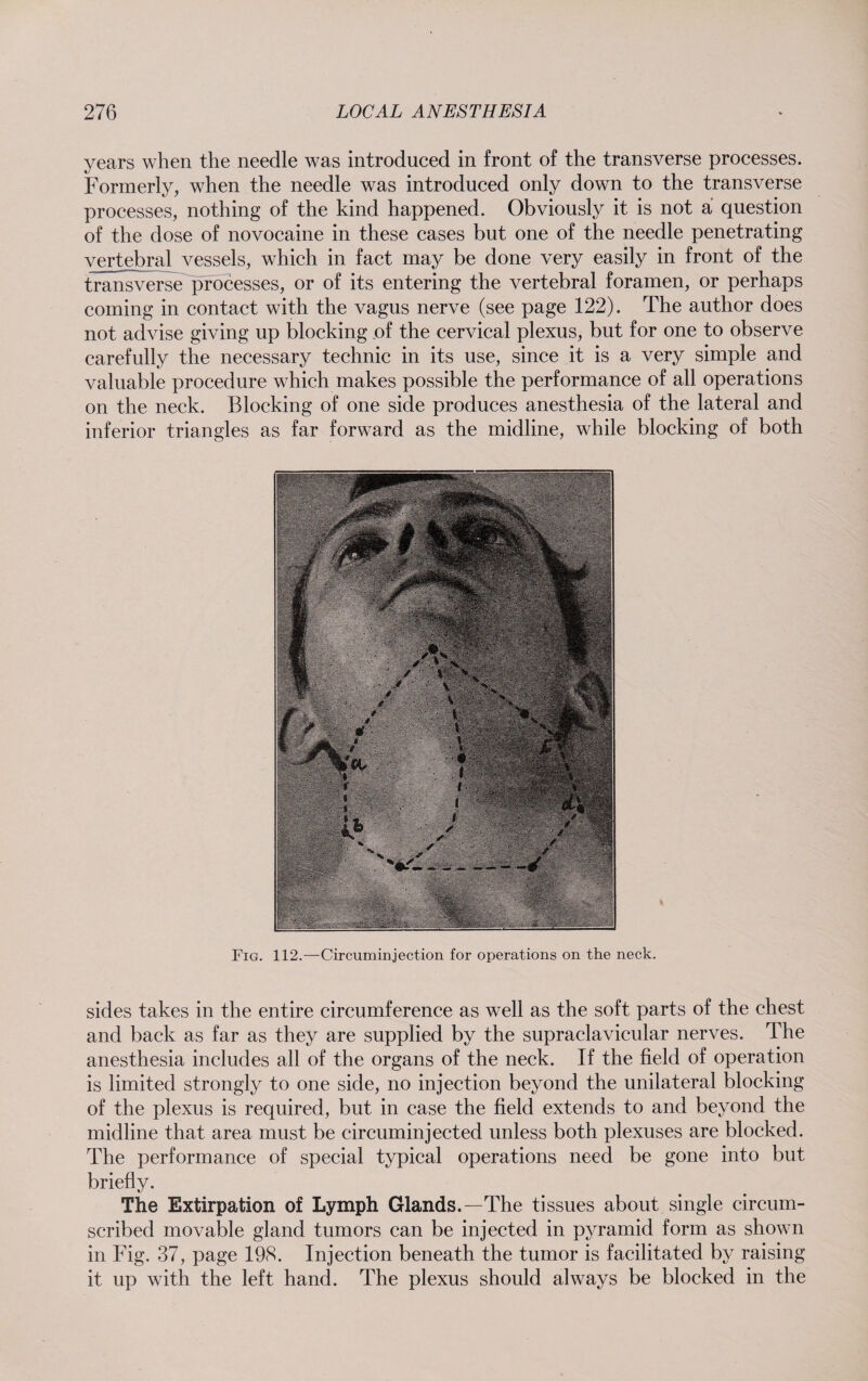 years when the needle was introduced in front of the transverse processes. Formerly, when the needle was introduced only down to the transverse processes, nothing of the kind happened. Obviously it is not a question of the dose of novocaine in these cases but one of the needle penetrating vertebral vessels, which in fact may be done very easily in front of the transverse processes, or of its entering the vertebral foramen, or perhaps coming in contact with the vagus nerve (see page 122). The author does not advise giving up blocking of the cervical plexus, but for one to observe carefully the necessary technic in its use, since it is a very simple and valuable procedure which makes possible the performance of all operations on the neck. Blocking of one side produces anesthesia of the lateral and inferior triangles as far forward as the midline, while blocking of both Fig. 112.—Circuminjection for operations on the neck. sides takes in the entire circumference as well as the soft parts of the chest and back as far as they are supplied by the supraclavicular nerves. The anesthesia includes all of the organs of the neck. If the field of operation is limited strongly to one side, no injection beyond the unilateral blocking of the plexus is required, but in case the field extends to and beyond the midline that area must be circuminjected unless both plexuses are blocked. The performance of special typical operations need be gone into but briefly. The Extirpation of Lymph Glands.—The tissues about single circum¬ scribed movable gland tumors can be injected in pyramid form as shown in Fig. 37, page 198. Injection beneath the tumor is facilitated by raising it up with the left hand. The plexus should always be blocked in the