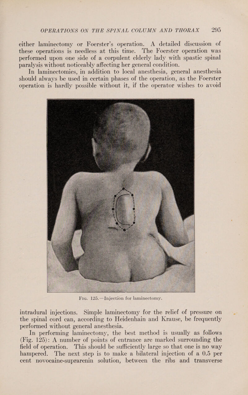 either laminectomy or Foerster’s operation. A detailed discussion of these operations is needless at this time. The Foerster operation was performed upon one side of a corpulent elderly lady with spastic spinal paralysis without noticeably affecting her general condition. In laminectomies, in addition to local anesthesia, general anesthesia should always be used in certain phases of the operation, as the Foerster operation is hardly possible without it, if the operator wishes to avoid Fig. 125.—Injection for laminectomy. intradural injections. Simple laminectomy for the relief of pressure on the spinal cord can, according to Heidenhain and Krause, be frequently performed without general anesthesia. In performing laminectomy, the best method is usually as follows (Fig. 125): A number of points of entrance are marked surrounding the field of operation. This should be sufficiently large so that one is no way hampered. The next step is to make a bilateral injection of a 0.5 per cent novocaine-suprarenin solution, between the ribs and transverse