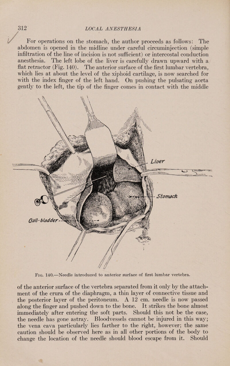 For operations on the stomach, the author proceeds as follows: The abdomen is opened in the midline under careful circuminjection (simple infiltration of the line of incision is not sufficient) or intercostal conduction anesthesia. The left lobe of the liver is carefully drawn upward with a flat retractor (Fig. 140). The anterior surface of the first lumbar vertebra, which lies at about the level of the xiphoid cartilage, is now searched for with the index finger of the left hand. On pushing the pulsating aorta gently to the left, the tip of the finger comes in contact with the middle „ Liver - Stomach (jail-bladder Fig. 140.—Needle introduced to anterior surface of first lumbar vertebra. of the anterior surface of the vertebra separated from it only by the attach¬ ment of the crura of the diaphragm, a thin layer of connective tissue and the posterior layer of the peritoneum. A 12 cm. needle is now passed along the finger and pushed down to the bone. It strikes the bone almost immediately after entering the soft parts. Should this not be the case, the needle has gone astray. Bloodvessels cannot be injured in this way; the vena cava particularly lies farther to the right, however; the same caution should be observed here as in all other portions of the body to change the location of the needle should blood escape from it. Should