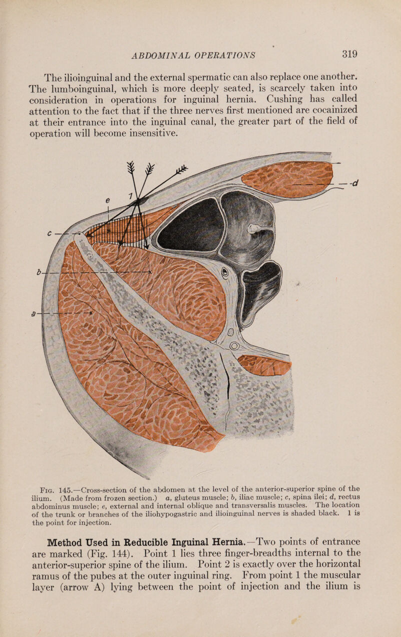 The ilioinguinal and the external spermatic can also replace one another. The lumboinguinal, which is more deeply seated, is scarcely taken into consideration in operations for inguinal hernia. Cushing has called attention to the fact that if the three nerves first mentioned are cocainized at their entrance into the inguinal canal, the greater part of the field of operation will become insensitive. Fig. 145.—Cross-section of the abdomen at the level of the anterior-superior spine of the ilium. (Made from frozen section.) a, gluteus muscle; b, iliac muscle; c, spina ilei; d, rectus abdominus muscle; e, external and internal oblique and transversalis muscles. The location of the trunk or branches of the iliohypogastric and ilioinguinal nerves is shaded black. 1 is the point for injection. Method Used in Reducible Inguinal Hernia.—Two points of entrance are marked (Fig. 144). Point 1 lies three finger-breadths internal to the anterior-superior spine of the ilium. Point 2 is exactly over the horizontal ramus of the pubes at the outer inguinal ring. From point 1 the muscular layer (arrow A) lying between the point of injection and the ilium is