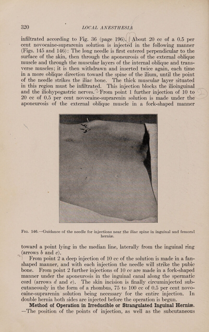 / I infiltrated according to Fig. 36 (page 196). j About 20 cc of a 0.5 per cent novocaine-suprarenin solution is injected in the following manner (Figs. 145 and 146): The long needle is first entered perpendicular to the surface of the skin, then through the aponeurosis of the external oblique muscle and through the muscular layers of the internal oblique and trans¬ verse muscles ; it is then withdrawn and inserted twice again, each time in a more oblique direction toward the spine of the ilium, until the point of the needle strikes the iliac bone. The thick muscular layer situated in this region must be infiltrated. This injection blocks the ilioinguinal and the iliohypogastric nerves. ’ From point 1 further injection of 10 to 20 cc of 0.5 per cent novocaine-suprarenin solution is made under the aponeurosis of the external oblique muscle in a fork-shaped manner Fig. 146.—Guidance of the needle for injections near the iliac spine in inguinal and femoral hernise. toward a point lying in the median line, laterally from the inguinal ring (arrows b and c). From point 2 a deep injection of 10 cc of the solution is made in a fan¬ shaped manner, and with each injection the needle will strike the pubic bone. From point 2 further injections of 10 cc are made in a fork-shaped manner under the aponeurosis in the inguinal canal along the spermatic cord (arrows d and e). The skin incision is finally circuminjected sub¬ cutaneously in the form of a rhombus, 75 to 100 cc of 0.5 per cent novo¬ caine-suprarenin solution being necessary for the entire injection. In double hernia both sides are injected before the operation is begun. Method of Operation in Irreducible or Strangulated Inguinal Herniae. —The position of the points of injection, as well as the subcutaneous