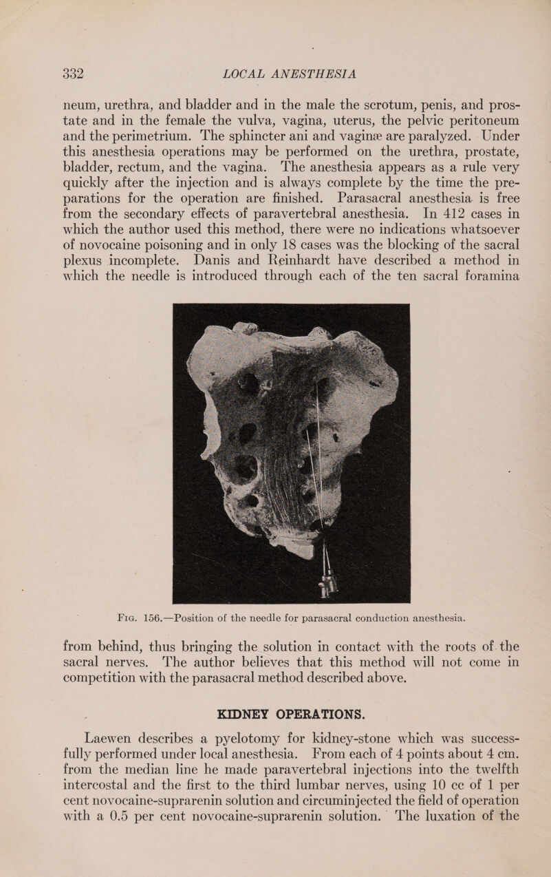 neum, urethra, and bladder and in the male the scrotum, penis, and pros¬ tate and in the female the vulva, vagina, uterus, the pelvic peritoneum and the perimetrium. The sphincter ani and vaginse are paralyzed. Under this anesthesia operations may be performed on the urethra, prostate, bladder, rectum, and the vagina. The anesthesia appears as a rule very quickly after the injection and is always complete by the time the pre¬ parations for the operation are finished. Parasacral anesthesia is free from the secondary effects of paravertebral anesthesia. In 412 cases in which the author used this method, there were no indications whatsoever of novocaine poisoning and in only 18 cases was the blocking of the sacral plexus incomplete. Danis and Reinhardt have described a method in which the needle is introduced through each of the ten sacral foramina Fig. 156.—Position of the needle for parasacral conduction anesthesia. from behind, thus bringing the solution in contact with the roots of the sacral nerves. The author believes that this method will not come in competition with the parasacral method described above. KIDNEY OPERATIONS. Laewen describes a pyelotomy for kidney-stone which was success¬ fully performed under local anesthesia. From each of 4 points about 4 cm. from the median line he made paravertebral injections into the twelfth intercostal and the first to the third lumbar nerves, using 10 cc of 1 per cent novocaine-suprarenin solution and circuminjected the field of operation with a 0.5 per cent novocaine-suprarenin solution. The luxation of the