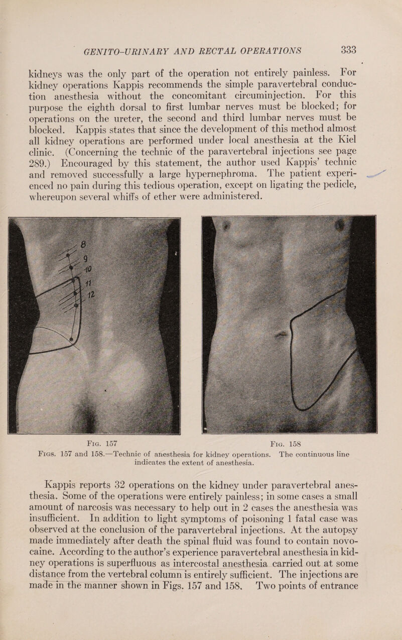 kidneys was the only part of the operation not entirely painless. For kidney operations Käppis recommends the simple paravertebral conduc¬ tion anesthesia without the concomitant circuminjection. For this purpose the eighth dorsal to first lumbar nerves must be blocked; for operations on the ureter, the second and third lumbar nerves must be blocked. Käppis states that since the development of this method almost all kidney operations are performed under local anesthesia at the Kiel clinic. (Concerning the technic of the paravertebral injections see page 289.) Encouraged by this statement, the author used Käppis’ technic and removed successfully a large hypernephroma. The patient experi¬ enced no pain during this tedious operation, except on ligating the pedicle, whereupon several whiffs of ether were administered. Fig. 157 Fig. 158 Figs. 157 and 158.—Technic of anesthesia for kidney operations. The continuous line indicates the extent of anesthesia. Käppis reports 32 operations on the kidney under paravertebral anes¬ thesia. Some of the operations were entirely painless; in some cases a small amount of narcosis was necessary to help out in 2 cases the anesthesia was insufficient. In addition to light symptoms of poisoning 1 fatal case was observed at the conclusion of the paravertebral injections. At the autopsy made immediately after death the spinal fluid was found to contain novo- caine. According to the author’s experience paravertebral anesthesia in kid¬ ney operations is superfluous as intercostal anesthesia carried out at some distance from the vertebral column is entirely sufficient. The injections are made in the manner shown in Figs. 157 and 158. Two points of entrance