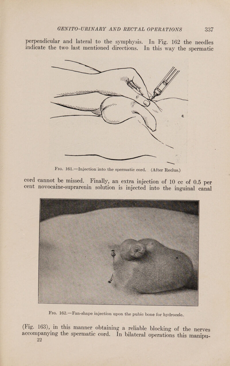 perpendicular and lateral to the symphysis. In Fig. 162 the needles indicate the two last mentioned directions. In this way the spermatic Fig. 161. Injection into the spermatic cord. (After Reclus.) cord cannot be missed. Finally, an extra injection of 10 cc of 0.5 per cent novocaine-suprarenin solution is injected into the inguinal canal Fig. 162. Fan shape injection upon the pubic bone for hydrocele. (lig. 163),. in this manner obtaining a reliable blocking of the nerves accompanying the spermatic cord. In bilateral operations this manrou- 22 ^