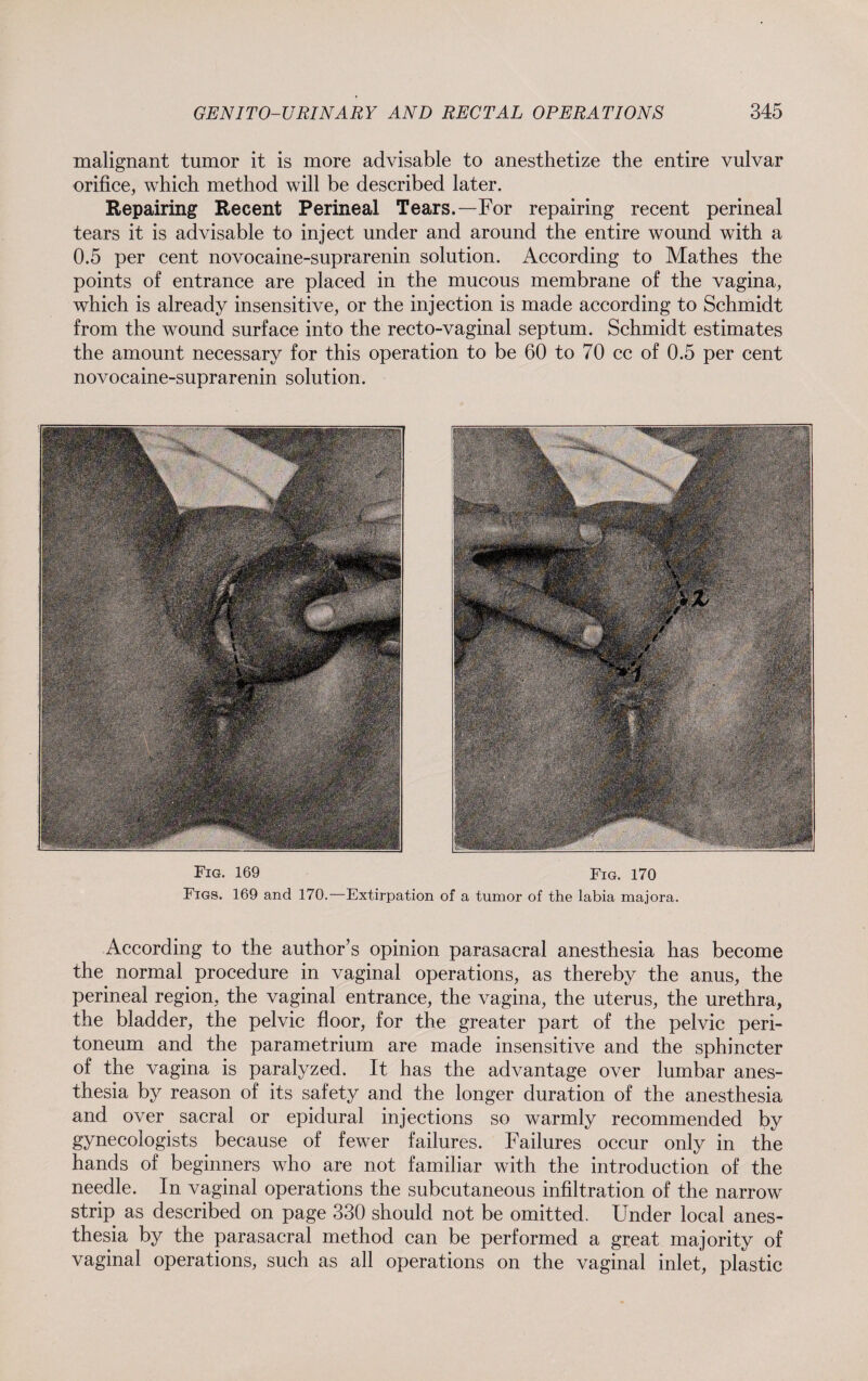 malignant tumor it is more advisable to anesthetize the entire vulvar orifice, which method will be described later. Repairing Recent Perineal Tears.—For repairing recent perineal tears it is advisable to inject under and around the entire wound with a 0.5 per cent novocaine-suprarenin solution. According to Mathes the points of entrance are placed in the mucous membrane of the vagina, which is already insensitive, or the injection is made according to Schmidt from the wound surface into the recto-vaginal septum. Schmidt estimates the amount necessary for this operation to be 60 to 70 cc of 0.5 per cent novocaine-suprarenin solution. Fig. 169 Fig. 170 Figs. 169 and 170.—Extirpation of a tumor of the labia majora. According to the author’s opinion parasacral anesthesia has become the normal procedure in vaginal operations, as thereby the anus, the perineal region, the vaginal entrance, the vagina, the uterus, the urethra, the bladder, the pelvic floor, for the greater part of the pelvic peri¬ toneum and the parametrium are made insensitive and the sphincter of the vagina is paralyzed. It has the advantage over lumbar anes¬ thesia by reason of its safety and the longer duration of the anesthesia and over sacral or epidural injections so warmly recommended by gynecologists because of fewer failures. Failures occur only in the hands of beginners who are not familiar with the introduction of the needle. In vaginal operations the subcutaneous infiltration of the narrow strip as described on page 330 should not be omitted. Under local anes¬ thesia by the parasacral method can be performed a great majority of vaginal operations, such as all operations on the vaginal inlet, plastic