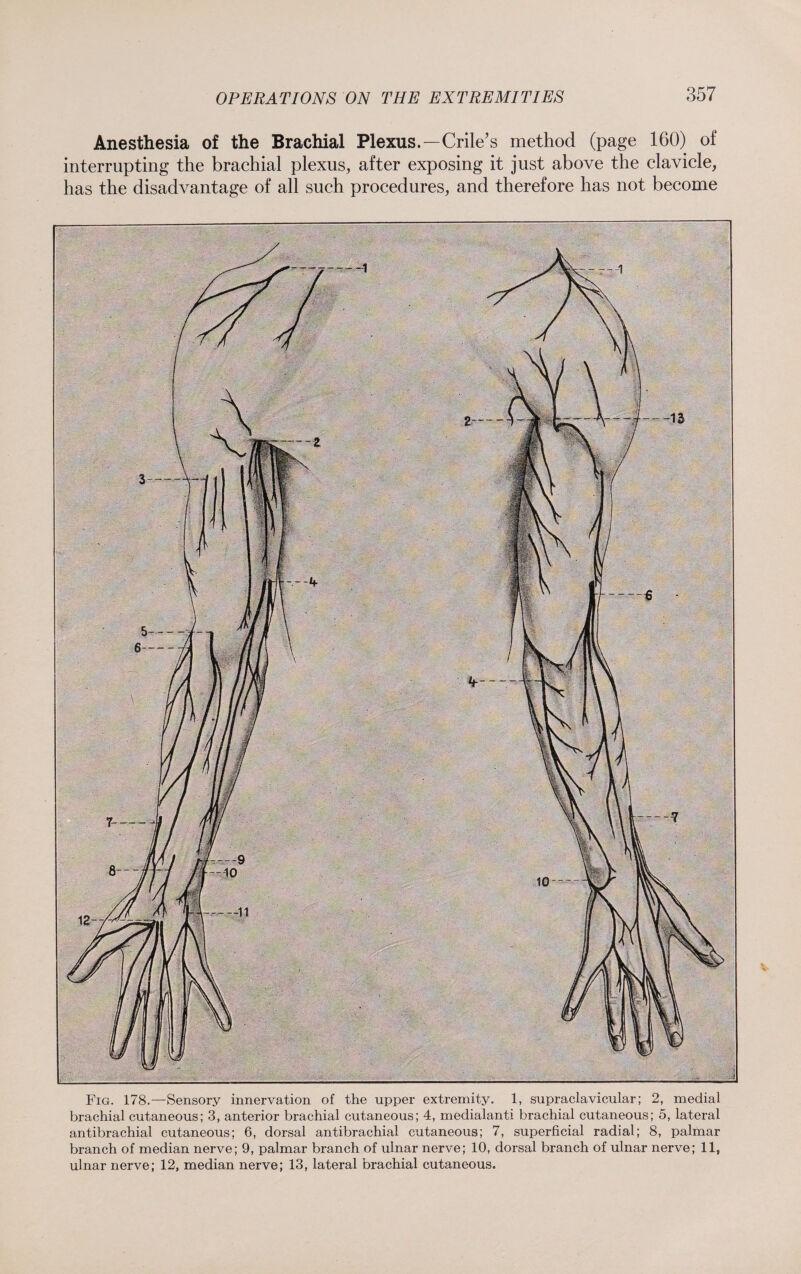 Anesthesia of the Brachial Plexus.—Crile’s method (page 160) of interrupting the brachial plexus, after exposing it just above the clavicle, has the disadvantage of all such procedures, and therefore has not become Fig. 178.—Sensory innervation of the upper extremity. 1, supraclavicular; 2, medial brachial cutaneous; 3, anterior brachial cutaneous; 4, medialanti brachial cutaneous; 5, lateral antibrachial cutaneous; 6, dorsal antibrachial cutaneous; 7, superficial radial; 8, palmar branch of median nerve; 9, palmar branch of ulnar nerve; 10, dorsal branch of ulnar nerve; 11, ulnar nerve; 12, median nerve; 13, lateral brachial cutaneous.