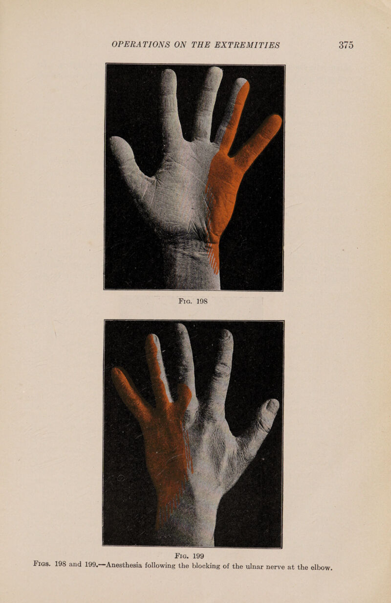 Fig. 198 Fig. 199 Figs. 198 and 199.—Anesthesia following the blocking of the ulnar nerve at the elbow.