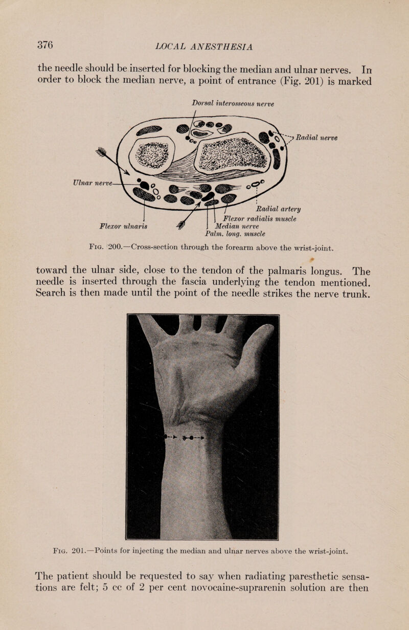 the needle should be inserted for blocking the median and ulnar nerves. In order to block the median nerve, a point of entrance (Fig. 201) is marked Dorsal interosseous nerve TJlnar nerve y Radial nerve Radial artery Flexor radialis muscle Flexor ulnaris Fig. 200.—Cross-section through the forearm above the wrist-joint. Median nerve Palm. long, muscle toward the ulnar side, close to the tendon of the palmaris longus. The needle is inserted through the fascia underlying the tendon mentioned. Search is then made until the point of the needle strikes the nerve trunk. Fig. 201.—Points for injecting the median and ulnar nerves above the wrist-joint. The patient should be requested to say when radiating paresthetic sensa¬ tions are felt; 5 cc of 2 per cent novocaine-suprarenin solution are then