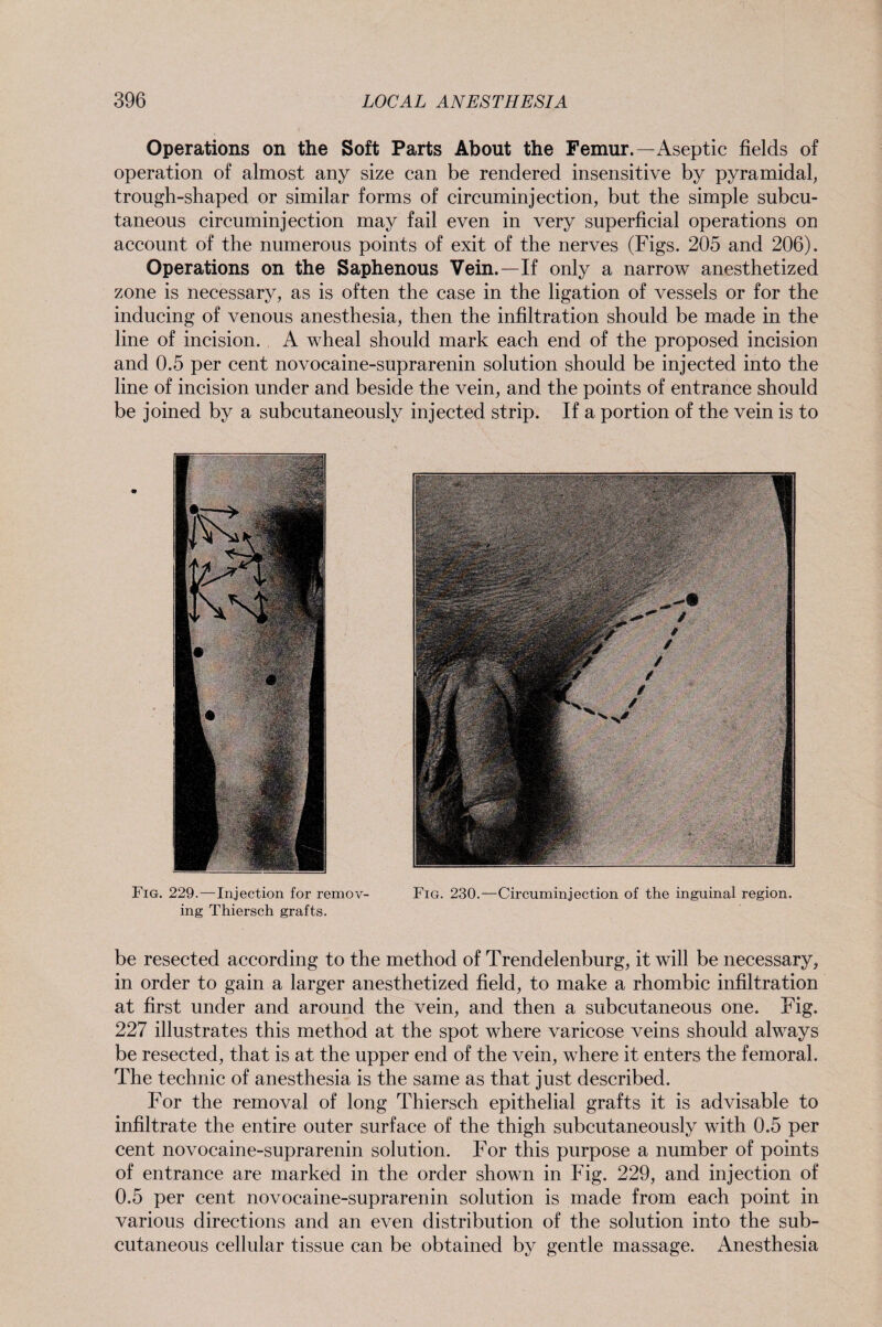 Fig. 229.—Injection for remov- Fig. 230.—Circuminjection of the inguinal region, ing Thiersch grafts. Operations on the Soft Parts About the Femur.—Aseptic fields of operation of almost any size can be rendered insensitive by pyramidal, trough-shaped or similar forms of circuminjection, but the simple subcu¬ taneous circuminjection may fail even in very superficial operations on account of the numerous points of exit of the nerves (Figs. 205 and 206). Operations on the Saphenous Vein.—If only a narrow anesthetized zone is necessary, as is often the case in the ligation of vessels or for the inducing of venous anesthesia, then the infiltration should be made in the line of incision. A wheal should mark each end of the proposed incision and 0.5 per cent novocaine-suprarenin solution should be injected into the line of incision under and beside the vein, and the points of entrance should be joined by a subcutaneously injected strip. If a portion of the vein is to be resected according to the method of Trendelenburg, it will be necessary, in order to gain a larger anesthetized field, to make a rhombic infiltration at first under and around the vein, and then a subcutaneous one. Fig. 227 illustrates this method at the spot where varicose veins should always be resected, that is at the upper end of the vein, where it enters the femoral. The technic of anesthesia is the same as that just described. For the removal of long Thiersch epithelial grafts it is advisable to infiltrate the entire outer surface of the thigh subcutaneously with 0.5 per cent novocaine-suprarenin solution. For this purpose a number of points of entrance are marked in the order shown in Fig. 229, and injection of 0.5 per cent novocaine-suprarenin solution is made from each point in various directions and an even distribution of the solution into the sub¬ cutaneous cellular tissue can be obtained by gentle massage. Anesthesia