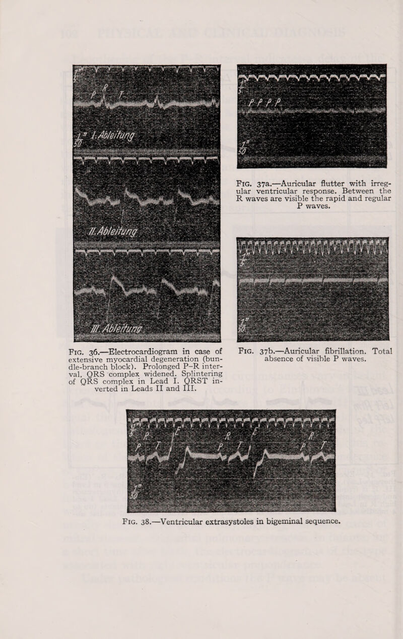 iftmirwiaMlrifVii' Fig. 37a.—Auricular flutter with irreg¬ ular ventricular response. Between the R waves are visible the rapid and regular P waves. Fig. 36.—Electrocardiogram in case of extensive myocardial degeneration (bun¬ dle-branch block). Prolonged P-R inter¬ val, QRS complex widened. Splintering of QRS complex in Lead I. QRST in¬ verted in Leads II and III. Fig. 37b.—Auricular fibrillation. Total absence of visible P waves.