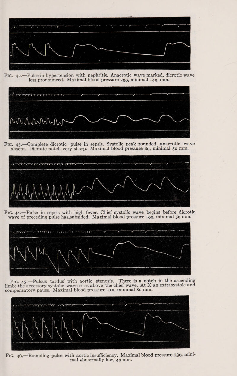 Fig. 42.—Pulse in hypertension with nephritis. Anacrotic wave marked, dicrotic wave less pronounced. Maximal blood pressure 200, minimal 140 mm. Fig. 43.—Complete dicrotic pulse in sepsis. Systolic peak rounded, anacrotic wave absent. Dicrotic notch very sharp. Maximal blood pressure 80, minimal 50 mm. Fig. 44.—Pulse in sepsis with high fever. Chief systolic wave begins before dicrotic wave of preceding pulse has.subsided. Maximal blood pressure 100, minimal so mm. Fig. —Pulsus tardus' with aortic stenosis. There is a notch in the ascending limb; the accessory systolic wave rises above the chief wave. At X an extrasystole and compensatory pause. Maximal blood pressure no, minimal 80 mm. Fig. 46.—Bounding pulse with aortic insufficiency. Maximal blood pressure 130, mini¬ mal abnormally low, 40 mm.