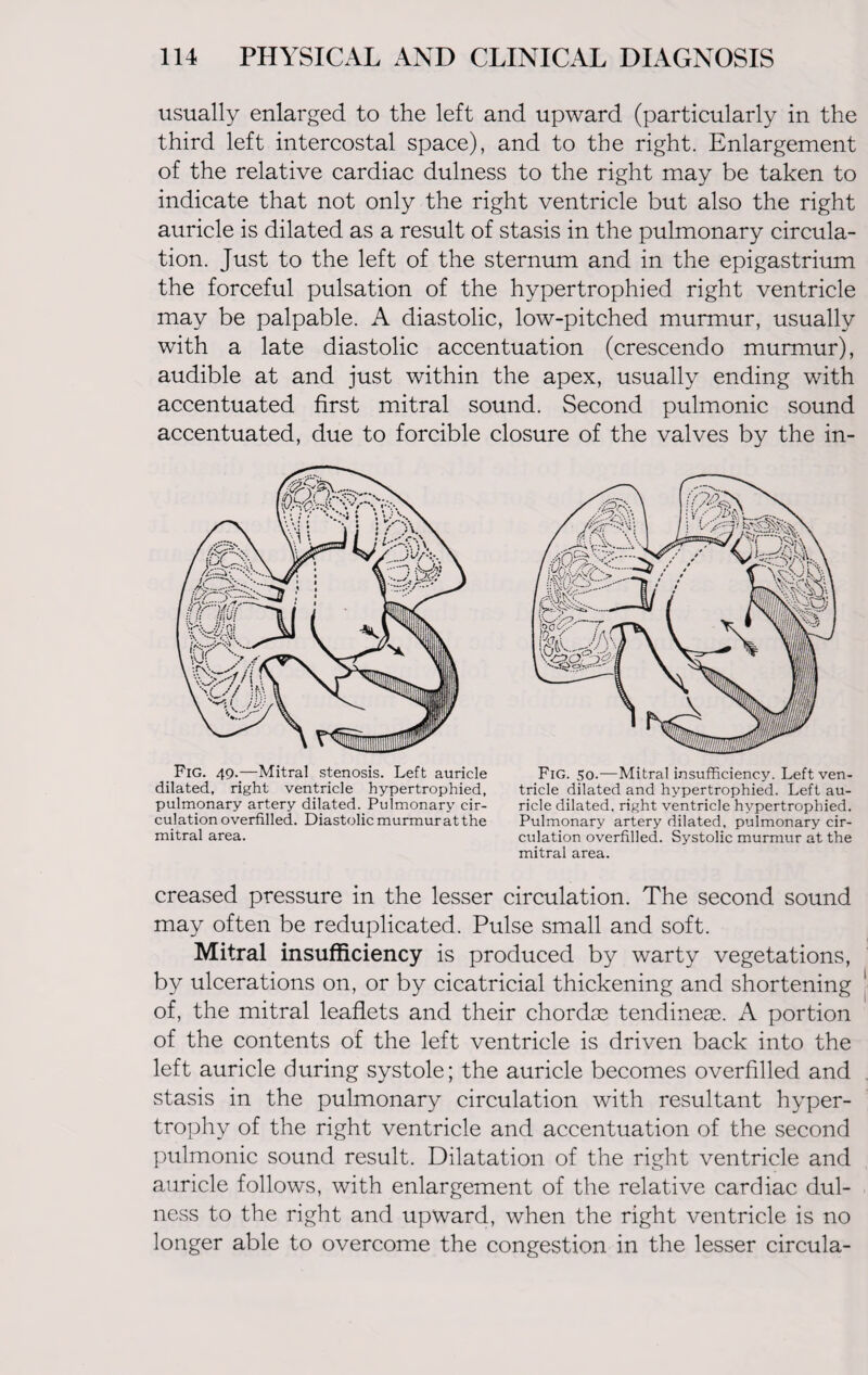 usually enlarged to the left and upward (particularly in the third left intercostal space), and to the right. Enlargement of the relative cardiac dulness to the right may be taken to indicate that not only the right ventricle but also the right auricle is dilated as a result of stasis in the pulmonary circula¬ tion. Just to the left of the sternum and in the epigastrium the forceful pulsation of the hypertrophied right ventricle may be palpable. A diastolic, low-pitched murmur, usually with a late diastolic accentuation (crescendo murmur), audible at and just within the apex, usually ending with accentuated first mitral sound. Second pulmonic sound accentuated, due to forcible closure of the valves by the in- FiG. 49.—Mitral stenosis. Left auricle dilated, right ventricle hypertrophied, pulmonary artery dilated. Pulmonary cir¬ culation overfilled. Diastolic murmuratthe mitral area. Fig. 50.—Mitral insufficiency. Left ven¬ tricle dilated and hypertrophied. Left au¬ ricle dilated, right ventricle hypertrophied. Pulmonary artery dilated, pulmonary cir¬ culation overfilled. Systolic murmur at the mitral area. creased pressure in the lesser circulation. The second sound may often be reduplicated. Pulse small and soft. Mitral insufficiency is produced by warty vegetations, by ulcerations on, or by cicatricial thickening and shortening of, the mitral leaflets and their chordae tendineae. A portion of the contents of the left ventricle is driven back into the left auricle during systole; the auricle becomes overfilled and stasis in the pulmonary circulation with resultant hyper¬ trophy of the right ventricle and accentuation of the second pulmonic sound result. Dilatation of the right ventricle and auricle follows, with enlargement of the relative cardiac dul¬ ness to the right and upward, when the right ventricle is no longer able to overcome the congestion in the lesser circula-