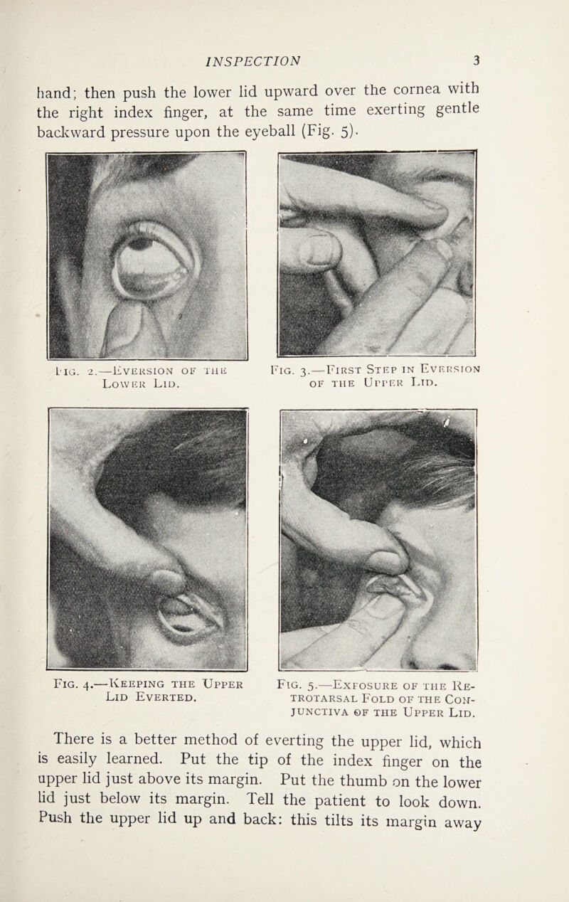 hand; then push the lower lid upward over the cornea with the right index finger, at the same time exerting gentle backward pressure upon the eyeball (Fig. 5)- L'Ig. 2.—Eversion of the Lower Lid. Fig. 3—First Step in Eversion of the Upper Ltd. Fig. 4.—Keeping the Upper Lid Everted. Fig. 5.—Exfosure of the Re- trotarsal Fold of the Con¬ junctiva of the Upper Lid. There is a better method of everting the upper lid, which is easily learned. Put the tip of the index finger on the upper lid just above its margin. Put the thumb on the lower lid just below its margin. Tell the patient to look down. Push the upper lid up and back: this tilts its margin away