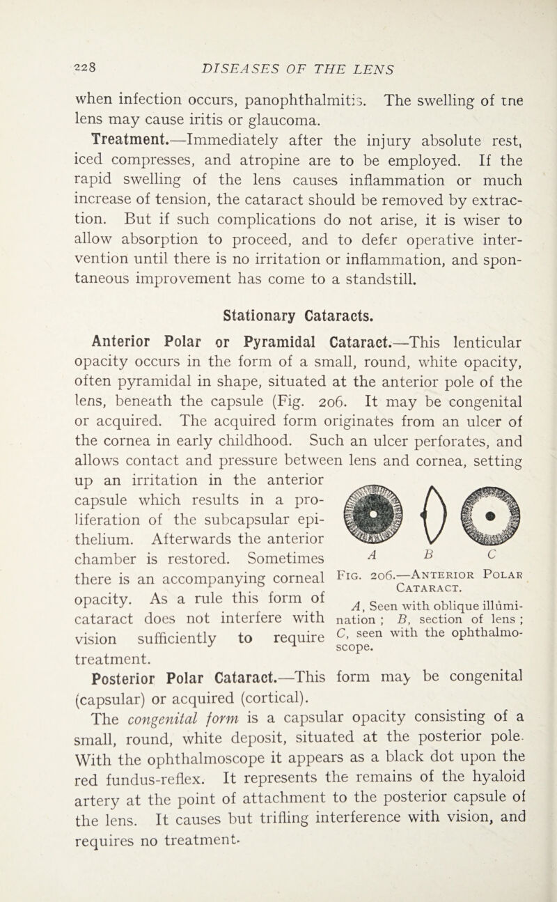 when infection occurs, panophthalmitis. The swelling of tne lens may cause iritis or glaucoma. Treatment.—Immediately after the injury absolute rest, iced compresses, and atropine are to be employed. If the rapid swelling of the lens causes inflammation or much increase of tension, the cataract should be removed by extrac¬ tion. But if such complications do not arise, it is wiser to allow absorption to proceed, and to defer operative inter¬ vention until there is no irritation or inflammation, and spon¬ taneous improvement has come to a standstill. Stationary Cataracts. Anterior Polar or Pyramidal Cataract.—This lenticular opacity occurs in the form of a small, round, white opacity, often pyramidal in shape, situated at the anterior pole of the lens, beneath the capsule (Fig. 206. It may be congenital or acquired. The acquired form originates from an ulcer of the cornea in early childhood. Such an ulcer perforates, and allows contact and pressure between lens and cornea, setting up an irritation in the anterior capsule which results in a pro¬ liferation of the subcapsular epi¬ thelium. Afterwards the anterior chamber is restored. Sometimes there is an accompanying corneal opacity. As a rule this form of cataract does not interfere with vision sufficiently to require treatment. Posterior Polar Cataract.—This (capsular) or acquired (cortical). The congenital form is a capsular opacity consisting of a small, round, white deposit, situated at the posterior pole. With the ophthalmoscope it appears as a black dot upon the red fundus-reflex. It represents the remains of the hyaloid artery at the point of attachment to the posterior capsule of the lens. It causes but trifling interference with vision, and requires no treatment* 0 A B Fig. 206.—Anterior Polar Cataract. A, Seen with oblique illumi¬ nation ; B, section of lens ; C, seen with the ophthalmo¬ scope. form may be congenital