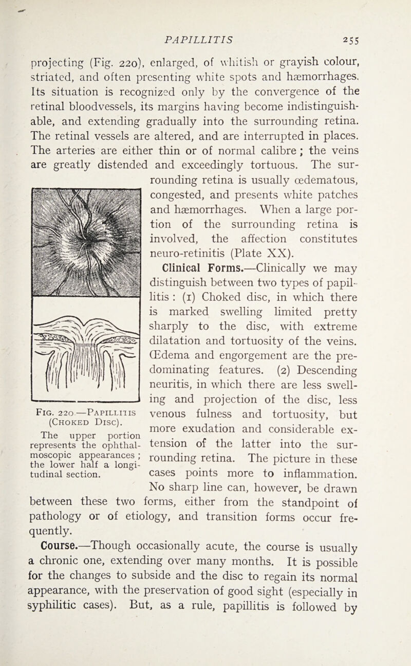 projecting (Fig. 220), enlarged, of whitish or grayish colour, striated, and often presenting white spots and haemorrhages. Its situation is recognized only by the convergence of the retinal bloodvessels, its margins having become indistinguish¬ able, and extending gradually into the surrounding retina. The retinal vessels are altered, and are interrupted in places. The arteries are either thin or of normal calibre ; the veins are greatly distended and exceedingly tortuous. The sur¬ rounding retina is usually cedematous, congested, and presents white patches and haemorrhages. When a large por¬ tion of the surrounding retina is involved, the affection constitutes neuro-retinitis (Plate XX). Clinical Forms.—Clinically we may distinguish between two types of papil¬ litis : (1) Choked disc, in which there is marked swelling limited pretty sharply to the disc, with extreme dilatation and tortuosity of the veins. (Edema and engorgement are the pre¬ dominating features. (2) Descending neuritis, in which there are less swell¬ ing and projection of the disc, less venous fulness and tortuosity, but more exudation and considerable ex¬ tension of the latter into the sur¬ rounding retina. The picture in these cases points more to inflammation. No sharp line can, however, be drawn between these two forms, either from the standpoint of pathology or of etiology, and transition forms occur fre¬ quently. Course.—Though occasionally acute, the course is usually a chronic one, extending over many months. It is possible for the changes to subside and the disc to regain its normal appearance, with the preservation of good sight (especially in syphilitic cases). But, as a rule, papillitis is followed by Fig. 220.—Papillitis (Choked Disc). The upper portion represents the ophthal¬ moscopic appearances ; the lower half a longi¬ tudinal section.