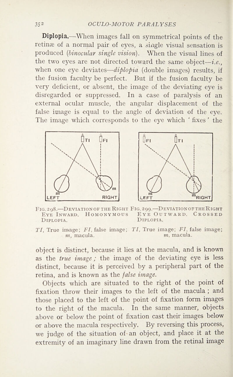 Diplopia.—-When images fall on symmetrical points of the retinae of a normal pair of eyes, a single visual sensation is produced (binocular single vision). When the visual lines of the two eyes are not directed toward the same object—i.e., when one eye deviates—diplopia (double images) results, if the fusion faculty be perfect. But if the fusion faculty be very deficient, or absent, the image of the deviating eye is disregarded or suppressed. In a case of paralysis of an external ocular muscle, the angular displacement of the false image is equal to the angle of deviation of the eye. The image which corresponds to the eye which ‘ fixes ’ the Fig.298.—Deviationof the Right Fig.299.—DeviationoftheRight Eye Inward. Homonymous Eye Outward. Crossed Diplopia. Diplopia. TI, True image; FI, false image; TI, True image; FI, false image; m, macula. m, macula. object is distinct, because it lies at the macula, and is known as the true image ; the image of the deviating eye is less distinct, because it is perceived by a peripheral part of the retina, and is known as the false image. Objects which are situated to the right of the point of fixation throw their images to the left of the macula ; and those placed to the left of the point of fixation form images to the right of the macula. In the same manner, objects above or below the point of fixation cast their images below or above the macula respectively. By reversing this process, we judge of the situation of an object, and place it at the extremity of an imaginary line drawn from the retinal image