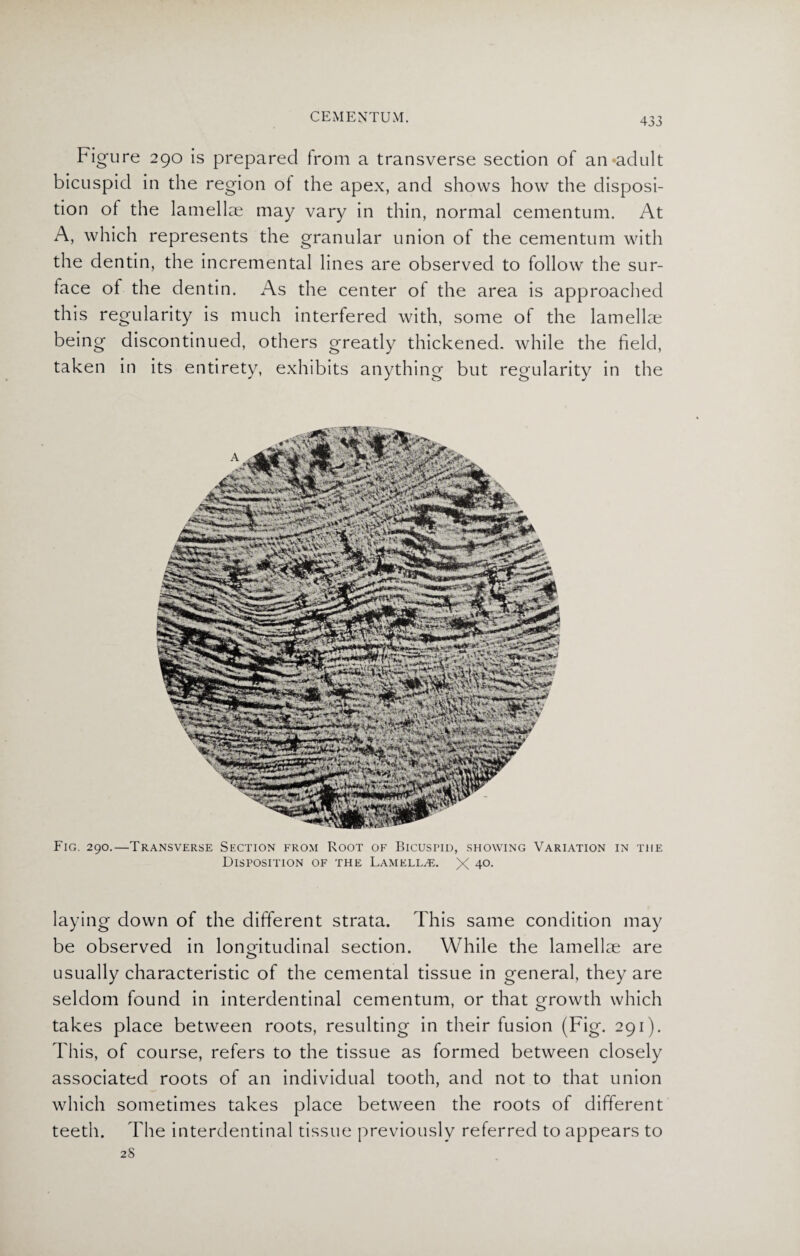 Figure 290 is prepared from a transverse section of an adult bicuspid in the region of the apex, and shows how the disposi¬ tion of the lamellae may vary in thin, normal cementum. At A, which represents the granular union of the cementum with the dentin, the incremental lines are observed to follow the sur¬ face of the dentin. As the center of the area is approached this regularity is much interfered with, some of the lamellae being discontinued, others greatly thickened, while the field, taken in its entirety, exhibits anything but regularity in the Fig. 290.—Transverse Section from Root of Bicuspid, showing Variation in the Disposition of the Lamella. X 4°- laying down of the different strata. This same condition may be observed in longitudinal section. While the lamellae are usually characteristic of the cemental tissue in general, they are seldom found in interdentinal cementum, or that growth which takes place between roots, resulting in their fusion (Fig. 291). This, of course, refers to the tissue as formed between closely associated roots of an individual tooth, and not to that union which sometimes takes place between the roots of different teeth. The interdentinal tissue previously referred to appears to 2S