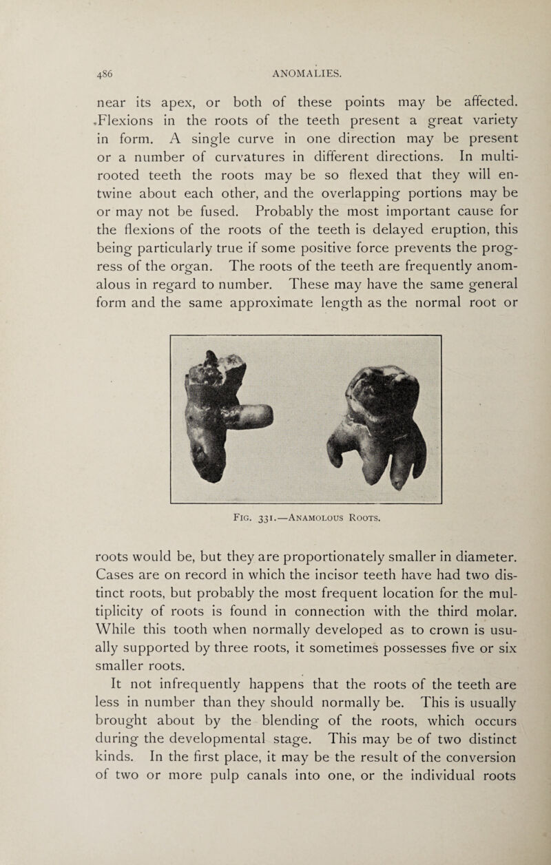 near its apex, or both of these points may be affected. .Flexions in the roots of the teeth present a great variety in form. A single curve in one direction may be present or a number of curvatures in different directions. In multi- rooted teeth the roots may be so flexed that they will en¬ twine about each other, and the overlapping portions may be or may not be fused. Probably the most important cause for the flexions of the roots of the teeth is delayed eruption, this being particularly true if some positive force prevents the prog¬ ress of the organ. The roots of the teeth are frequently anom¬ alous in regard to number. These may have the same general form and the same approximate length as the normal root or roots would be, but they are proportionately smaller in diameter. Cases are on record in which the incisor teeth have had two dis¬ tinct roots, but probably the most frequent location for the mul¬ tiplicity of roots is found in connection with the third molar. While this tooth when normally developed as to crown is usu¬ ally supported by three roots, it sometimes possesses five or six smaller roots. It not infrequently happens that the roots of the teeth are less in number than they should normally be. This is usually brought about by the blending of the roots, which occurs during the developmental stage. This may be of two distinct kinds. In the first place, it may be the result of the conversion of two or more pulp canals into one, or the individual roots