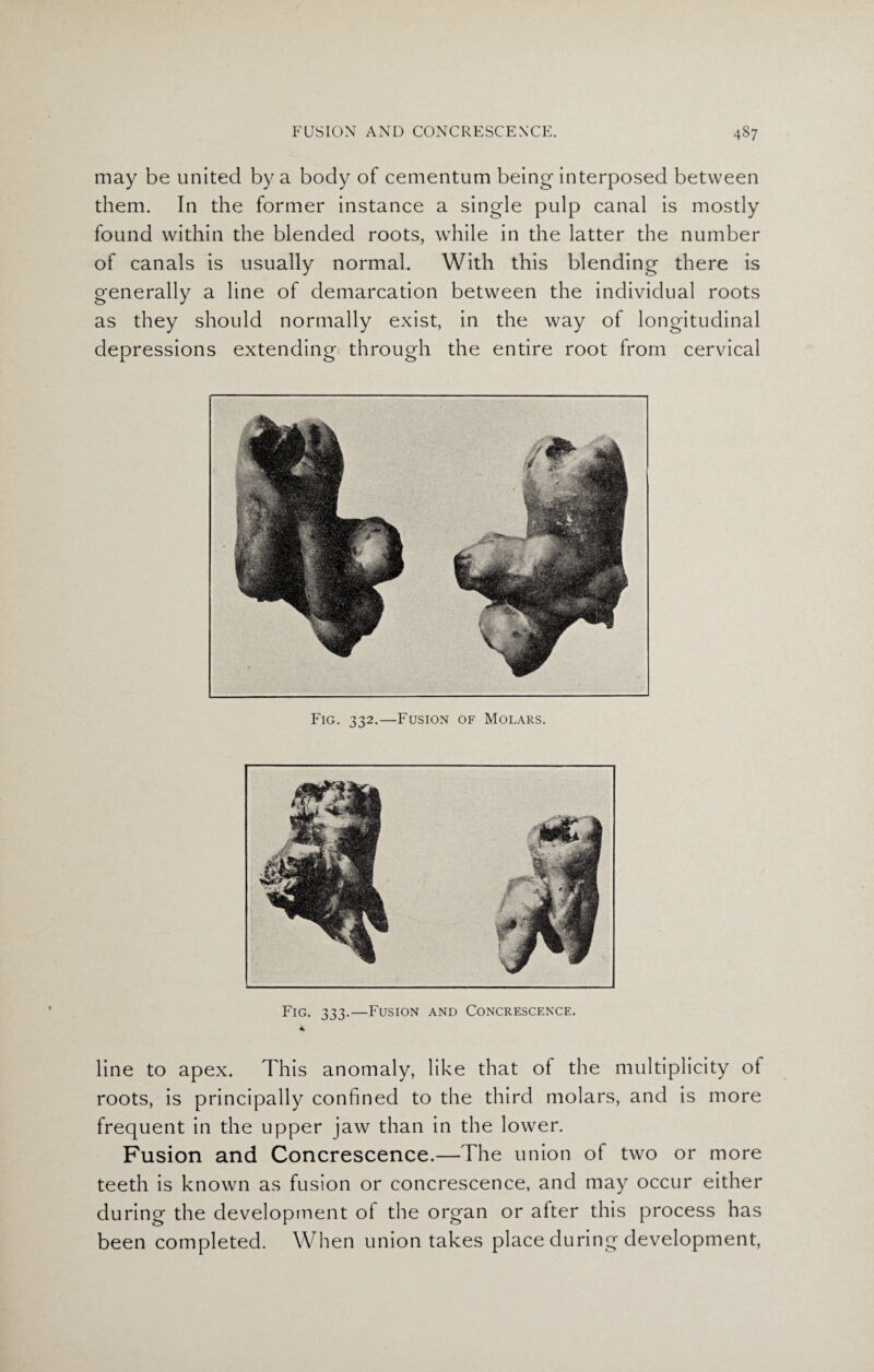 may be united by a body of cementum being interposed between them. In the former instance a single pulp canal is mostly found within the blended roots, while in the latter the number of canals is usually normal. With this blending there is generally a line of demarcation between the individual roots as they should normally exist, in the way of longitudinal depressions extending through the entire root from cervical Fig. 333.—Fusion and Concrescence. * line to apex. This anomaly, like that of the multiplicity of roots, is principally confined to the third molars, and is more frequent in the upper jaw than in the lower. Fusion and Concrescence.—The union of two or more teeth is known as fusion or concrescence, and may occur either during the development of the organ or after this process has been completed. When union takes place during development,