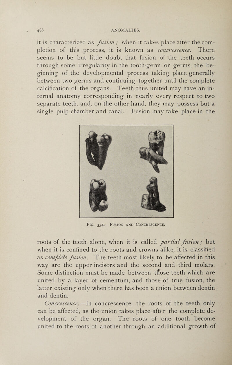 it is characterized as fusion ; when it takes place after the com¬ pletion of this process, it is known as concrescence. There seems to be but little doubt that fusion of the teeth occurs through some irregularity in the tooth-germ or germs, the be¬ ginning of the developmental process taking place generally between two germs and continuing together until the complete calcification of the organs. Teeth thus united may have an in¬ ternal anatomy corresponding in nearly every respect to two separate teeth, and, on the other hand, they may possess but a single pulp chamber and canal. Fusion may take place in the Fig. 334.—Fusion and Concrescence. roots of the teeth alone, when it is called partial fusion; but when it is confined to the roots and crowns alike, it is classified as complete fusion. The teeth most likely to be affected in this way are the upper incisors and the second and third molars. Some distinction must be made between tliose teeth which are united by a layer of cementum, and those of true fusion, the latter existing onlv when there has been a union between dentin and dentin. Concrescence.—In concrescence, the roots of the teeth only can be affected, as the union takes place after the complete de¬ velopment of the organ. The roots of one tooth become united to the roots of another through an additional growth of