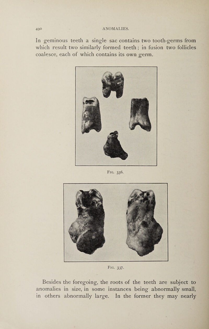 In geminous teeth a single sac contains two tooth-germs from which result two similarly formed teeth ; in fusion two follicles coalesce, each of which contains its own germ. Fig. 336. Fig. 337. Besides the foregoing, the roots of the teeth are subject to anomalies in size, in some instances being abnormally small, in others abnormally large. In the former they may nearly