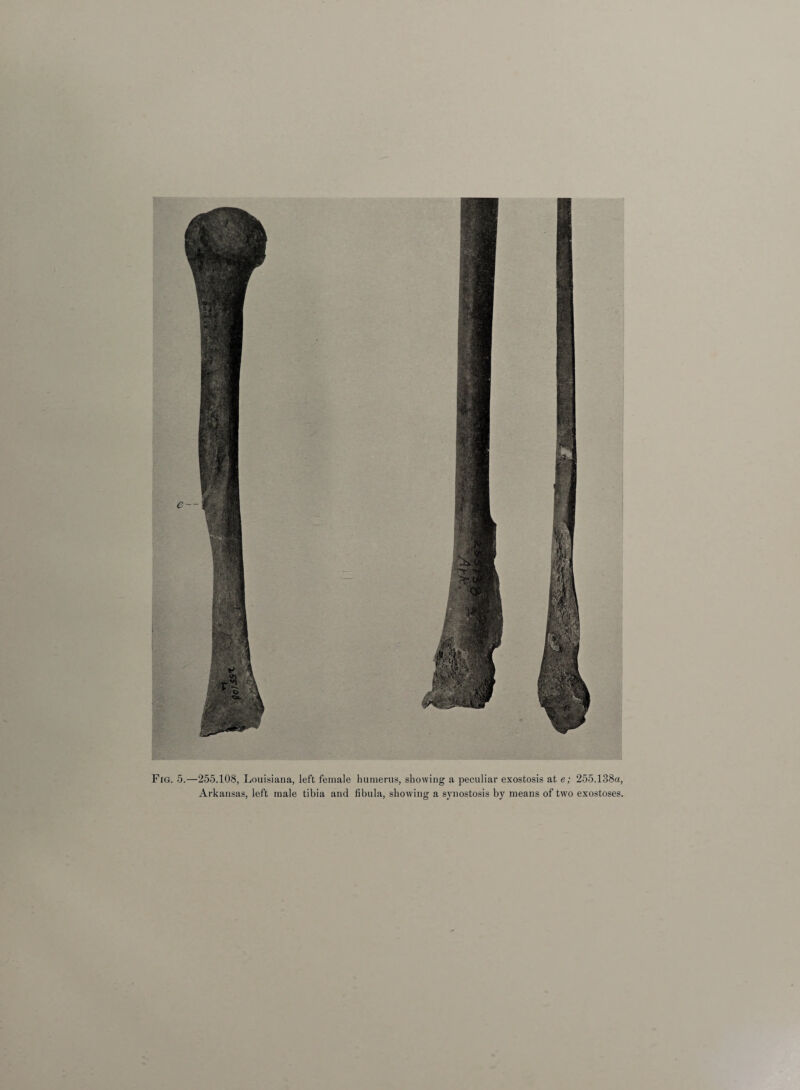 Fig. 5.—255.108, Louisiana, left female humerus, showing a peculiar exostosis at e; 255.138a, Arkansas, left male tibia and fibula, showing a synostosis by means of two exostoses.