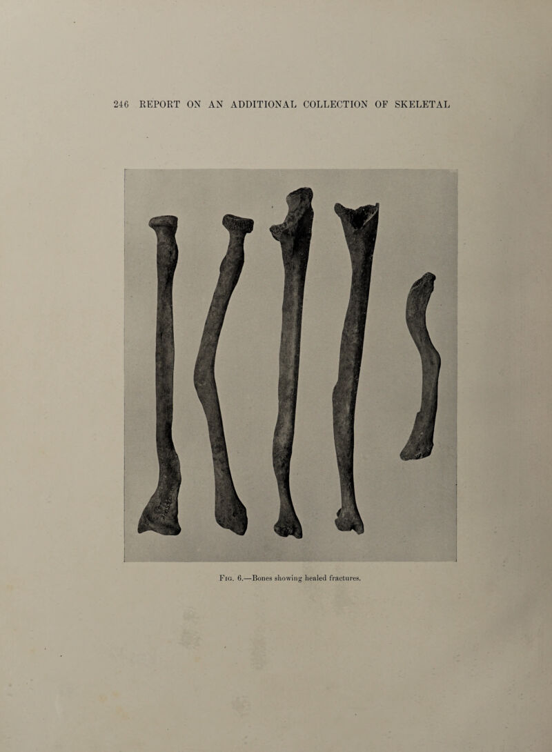 Fig. 6.—Bones showing healed fractures.